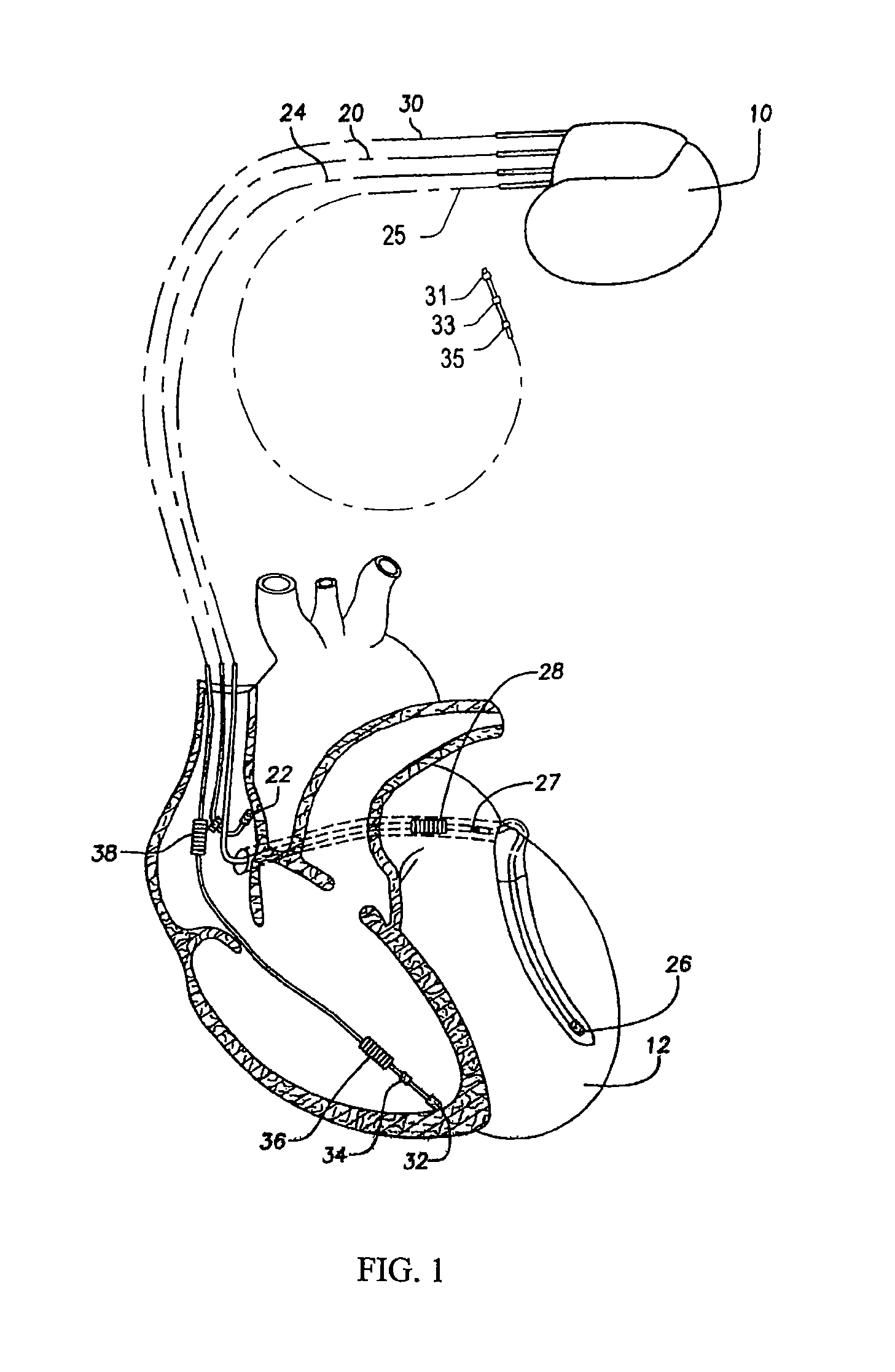 Systems and methods for detecting alternans in intrinsic rhythms to monitor myocardial stability