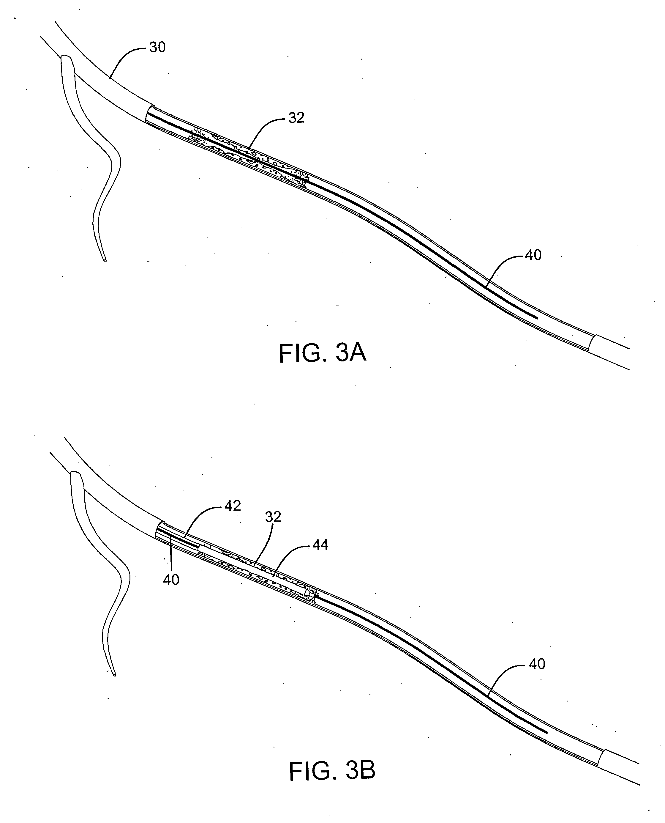 Sliding restraint stent delivery systems