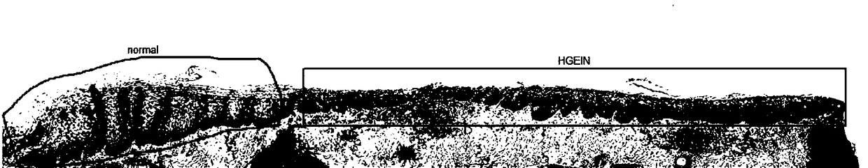 An esophageal cancer pathological image processing method based on depth learning