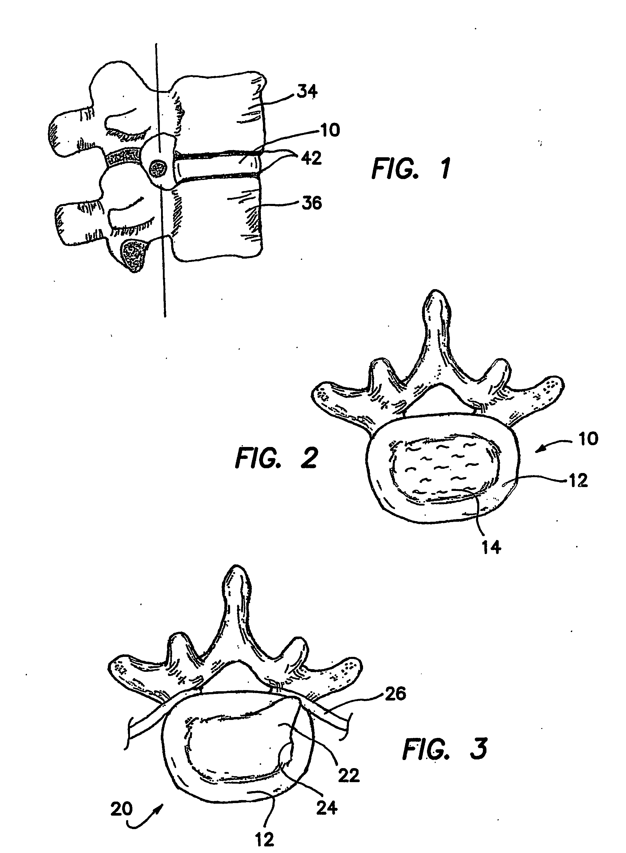 Artificial nucleus pulposus and method of injecting same