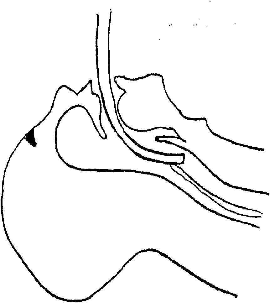 Guide device of endotracheal tube