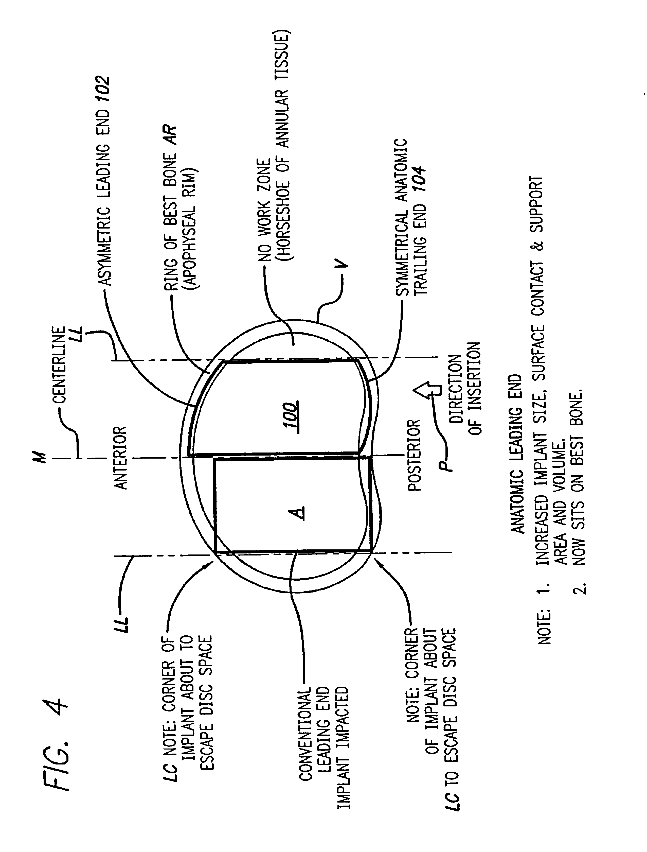 Bone hemi-lumbar interbody spinal fusion implant having an asymmetrical leading end and method of installation thereof