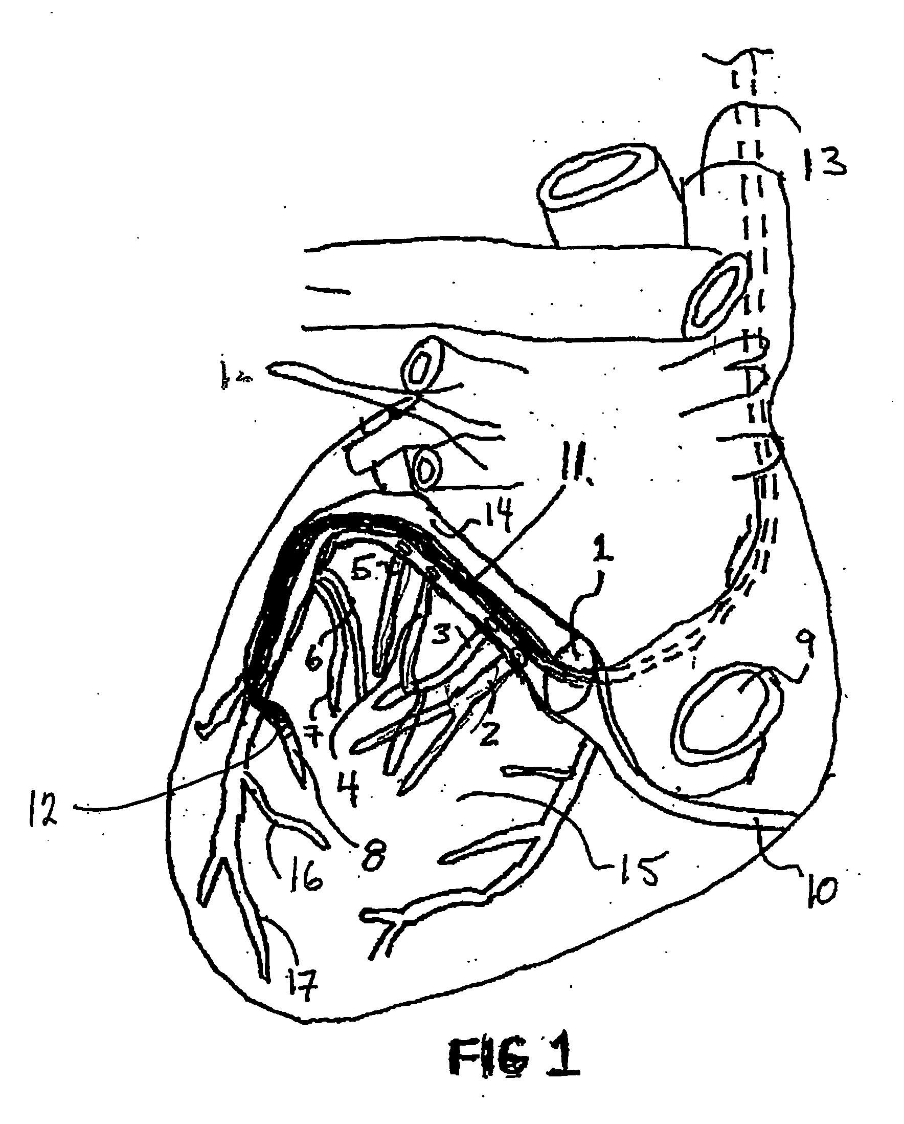 Coronary sinus access catheter with forward-imaging