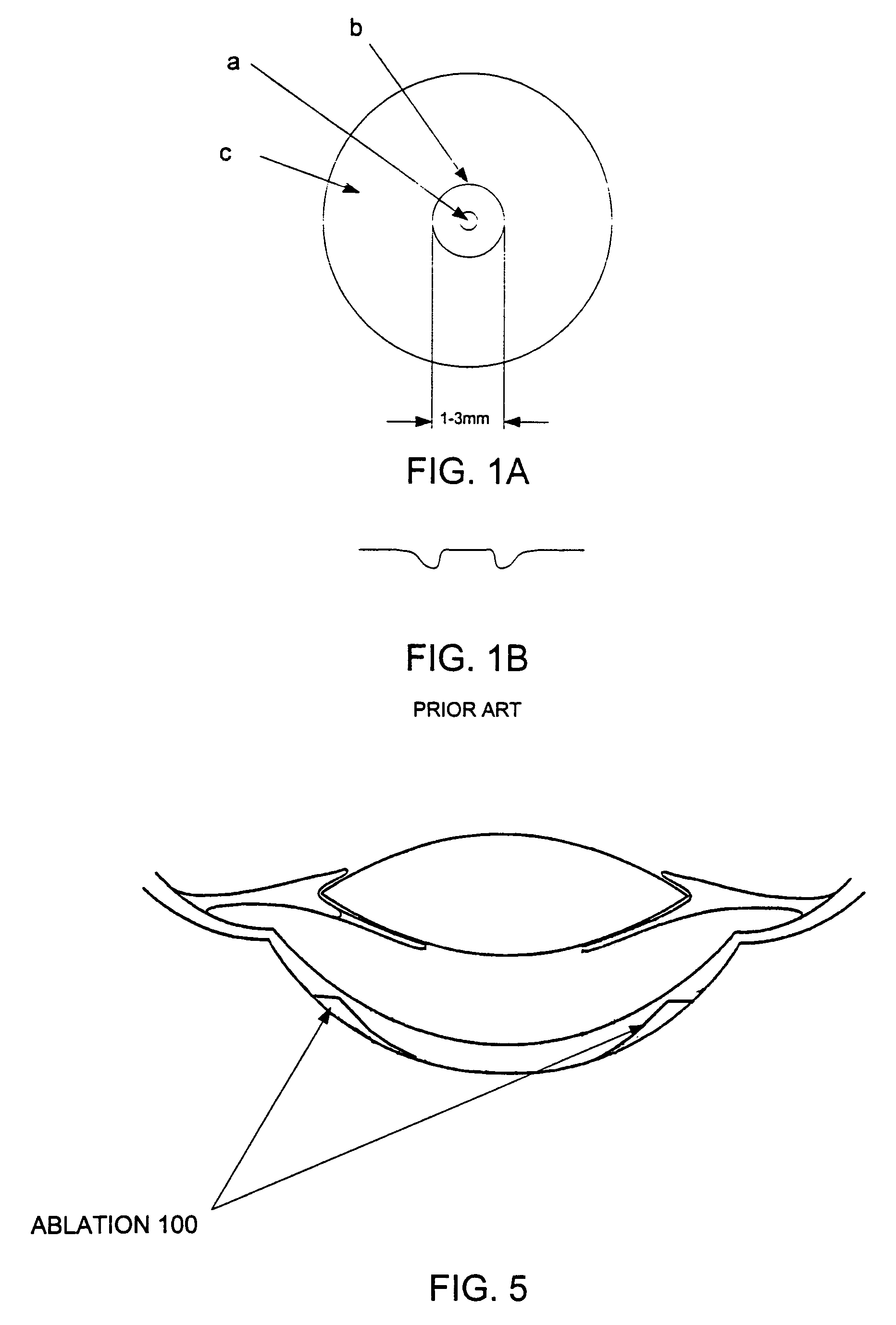 Method and apparatus for treating presbyopia