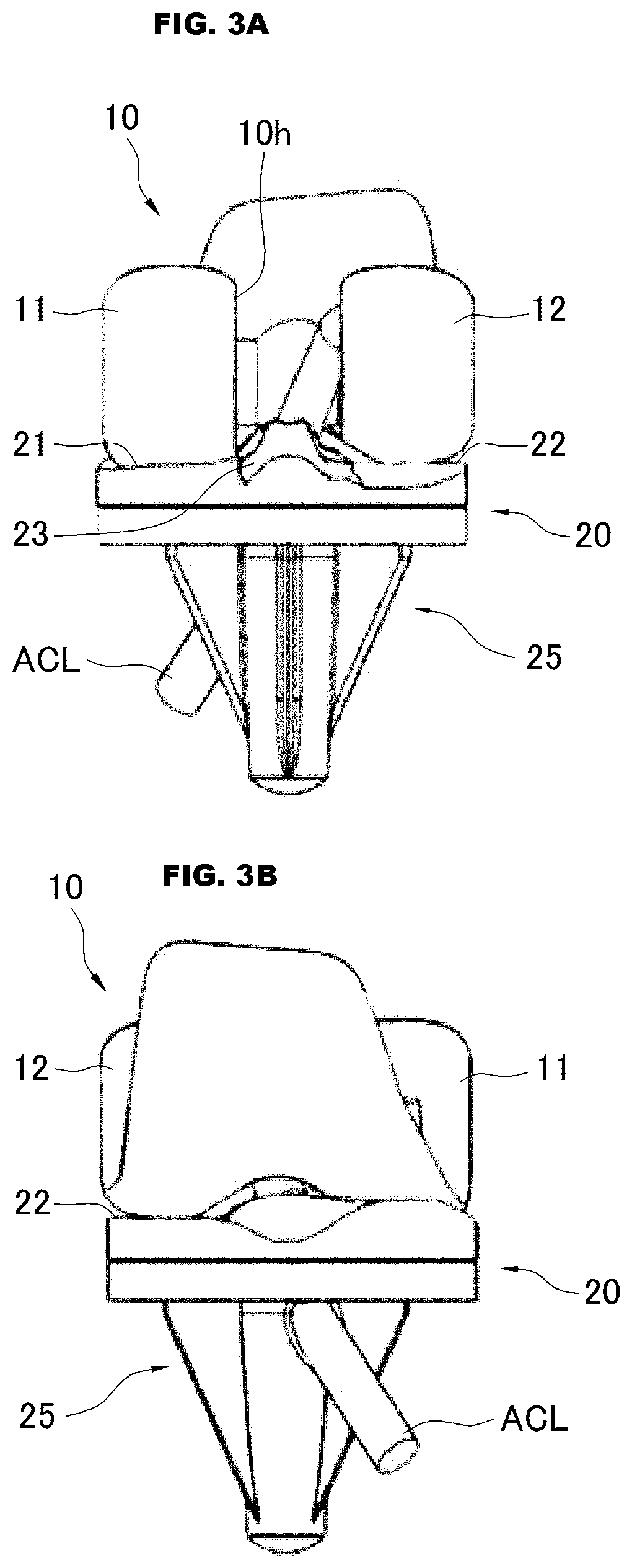 Artificial knee joint