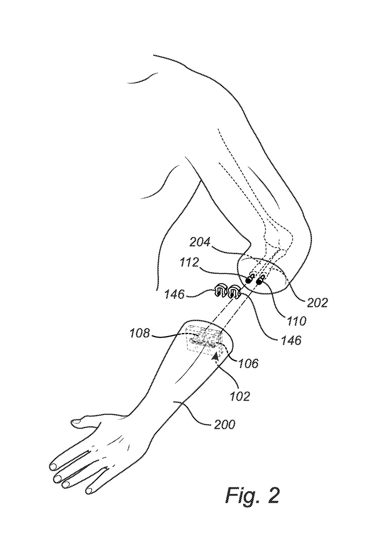 Attachment device allowing natural wrist rotation for osseointegrated prostheses