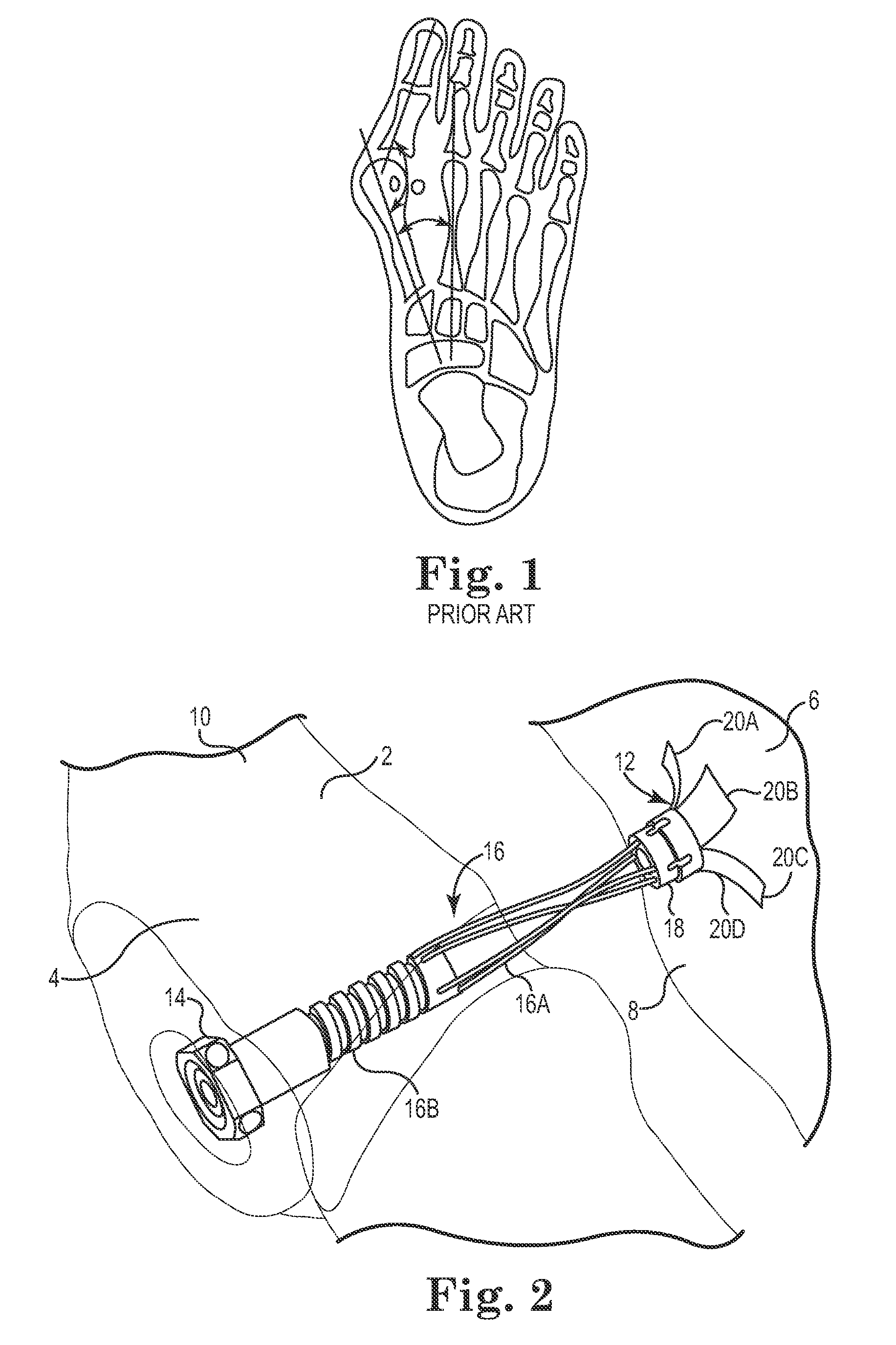 Methods and devices for treating hallux valgus