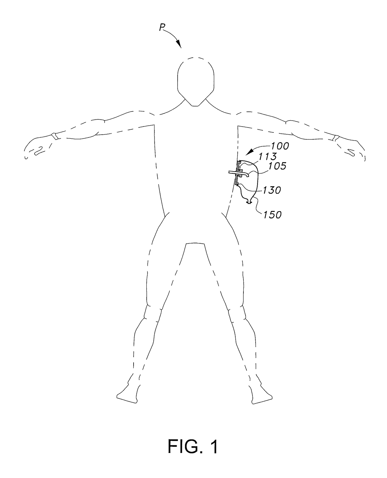 Surgical drain anchoring device