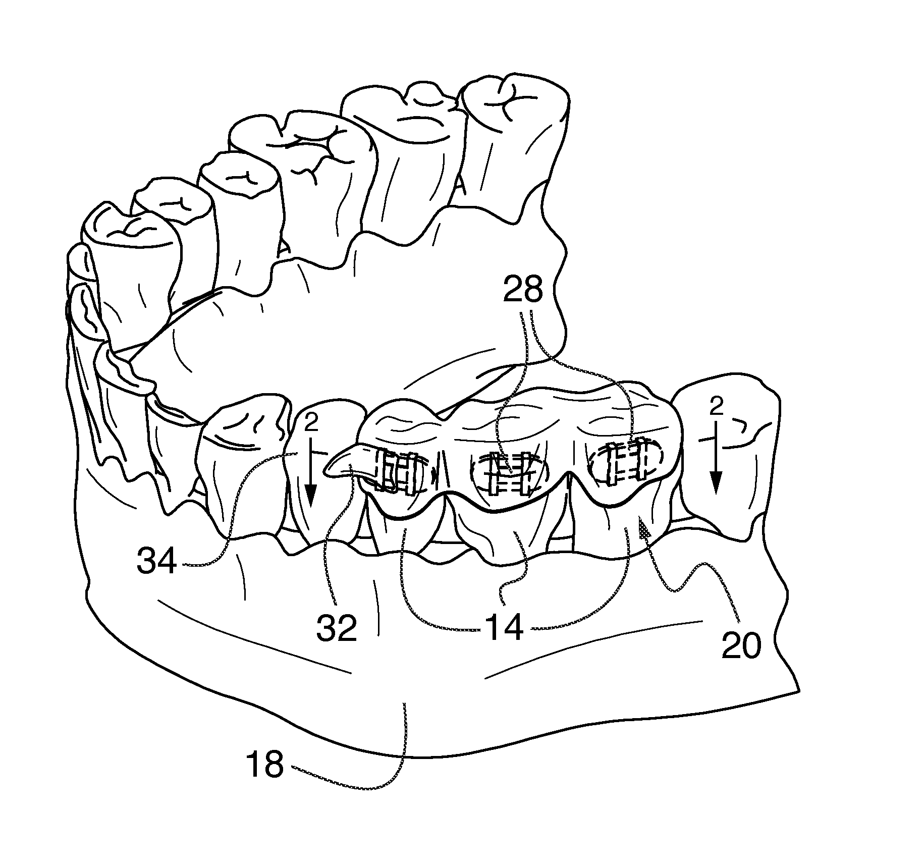 Orthodontic indirect bonding tray including stabilization features