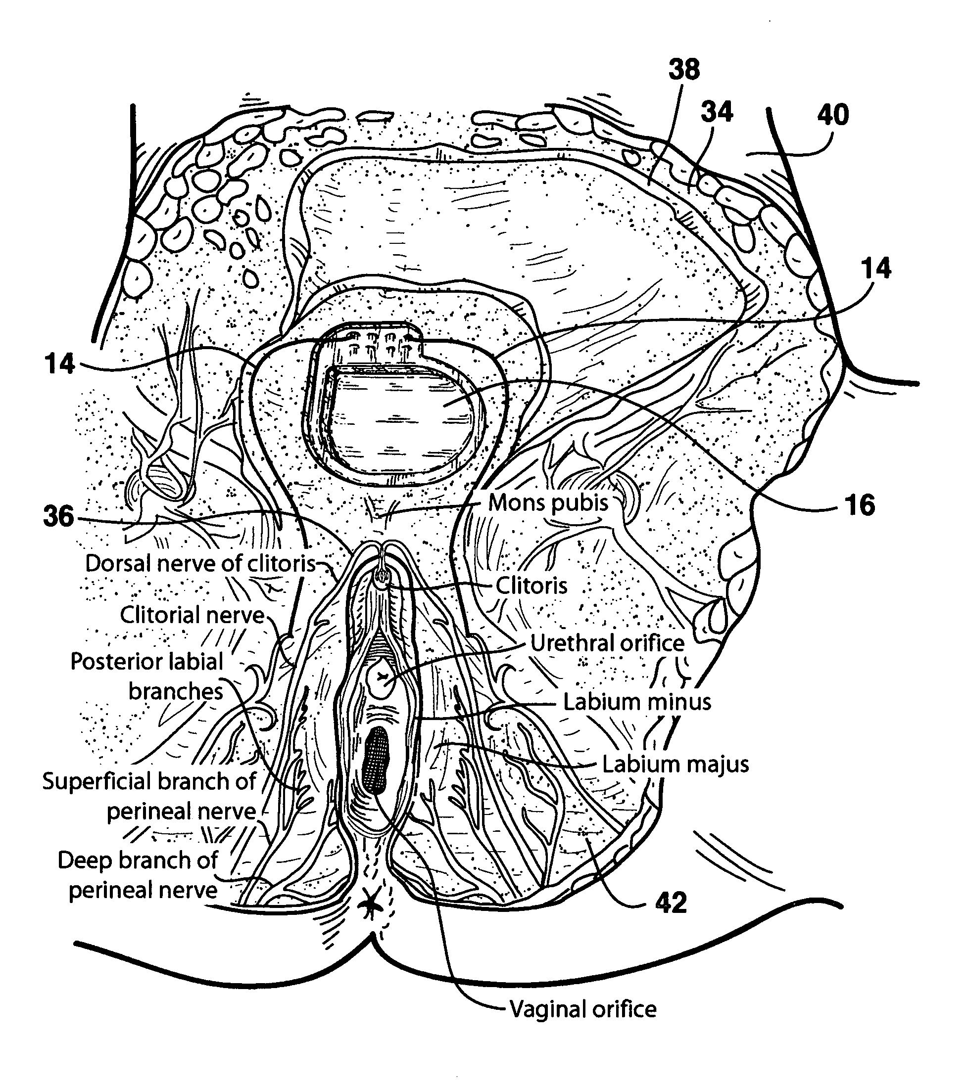 Method of treating female sexual dysfunction