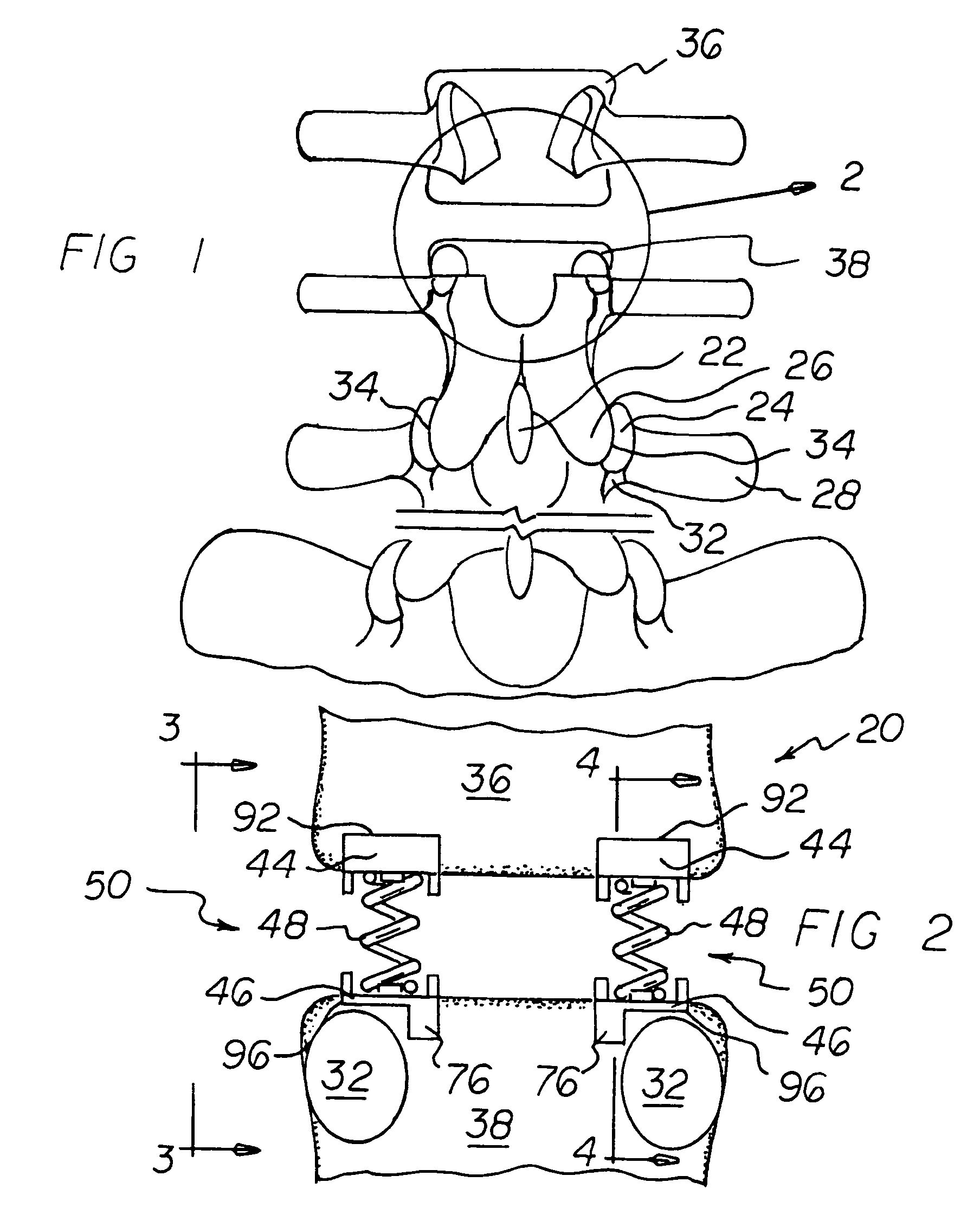 Vertebral implants adapted for posterior insertion