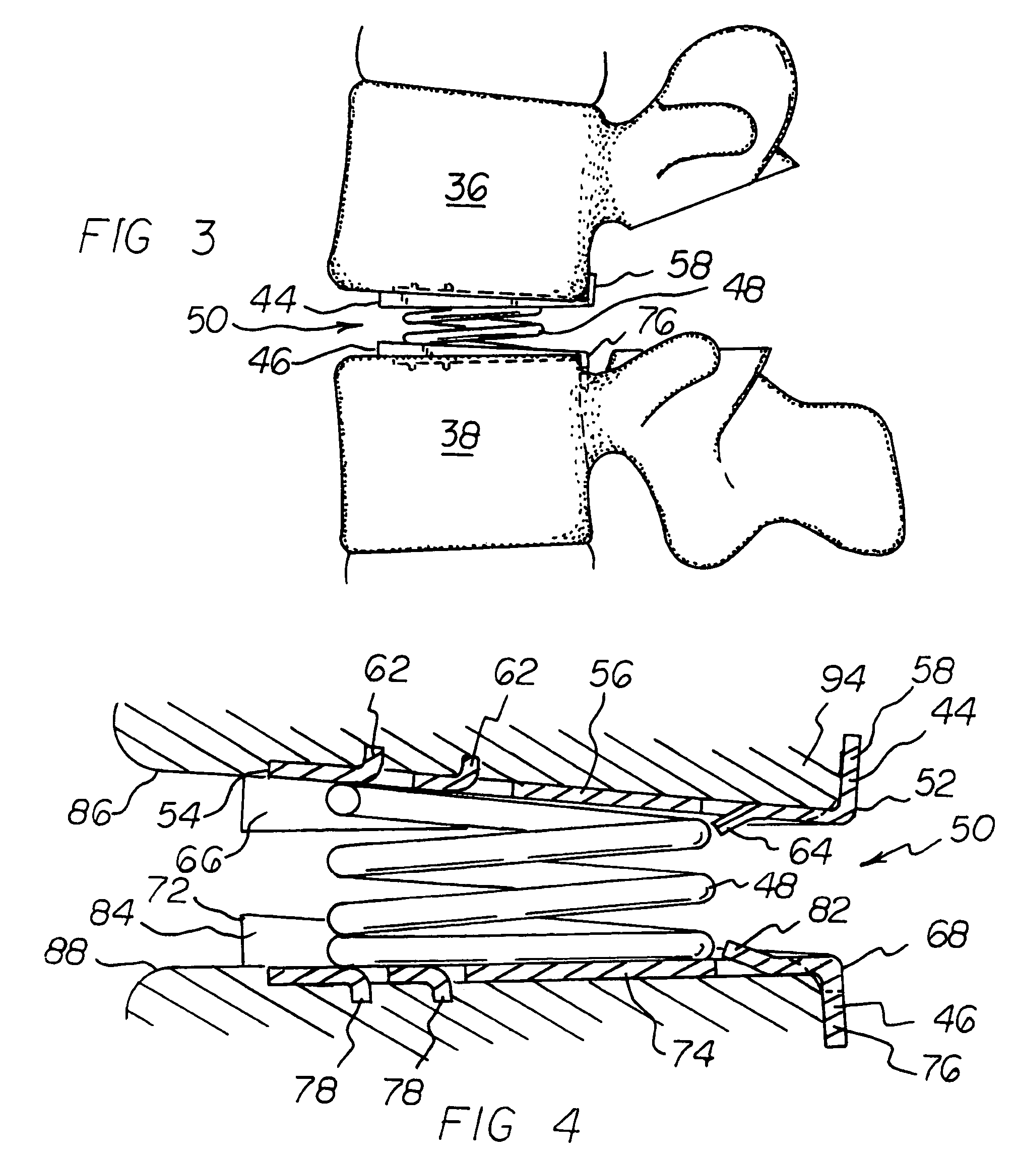 Vertebral implants adapted for posterior insertion