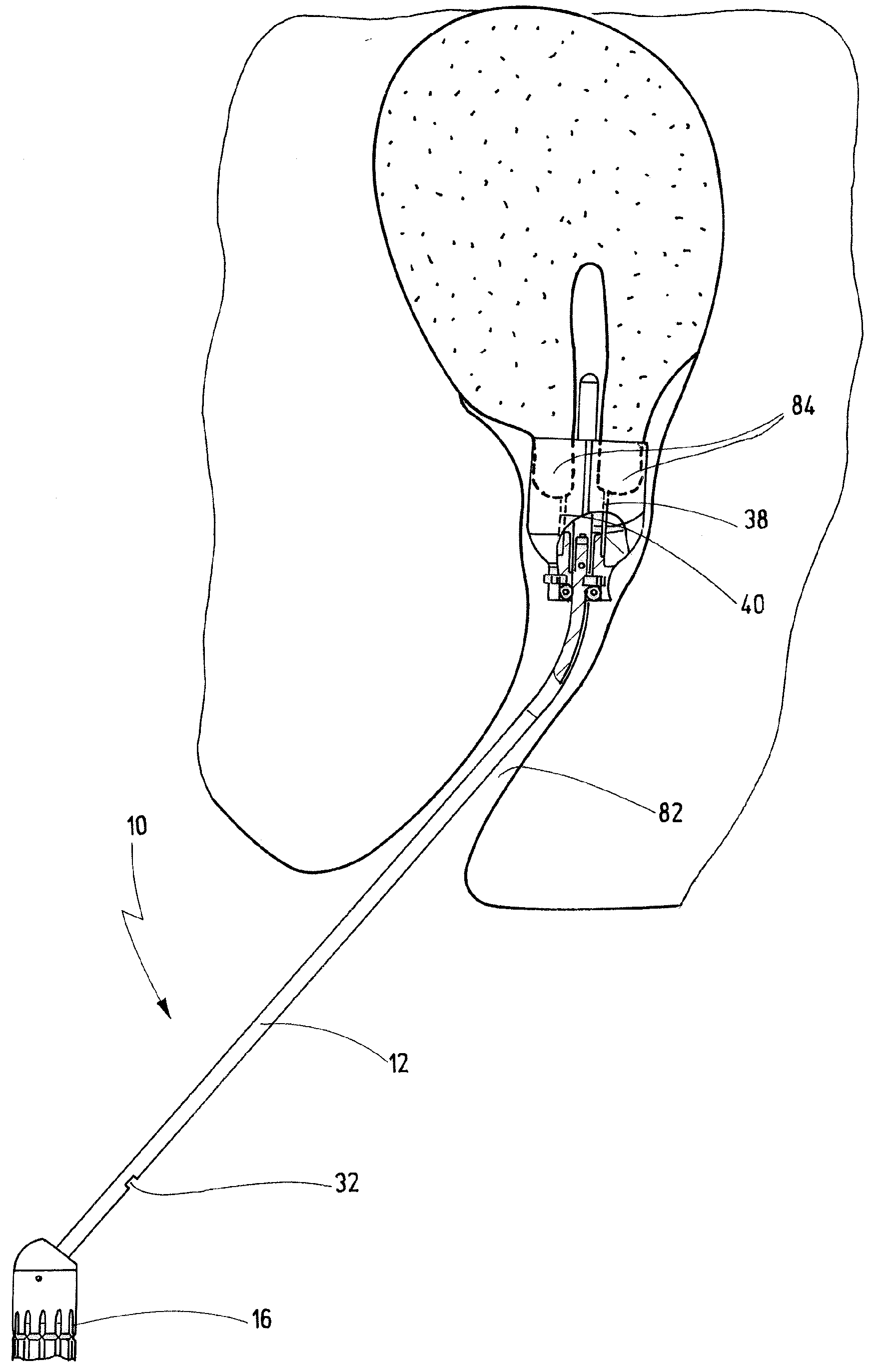 Medical Instrument For Manipulation Of An Uterus