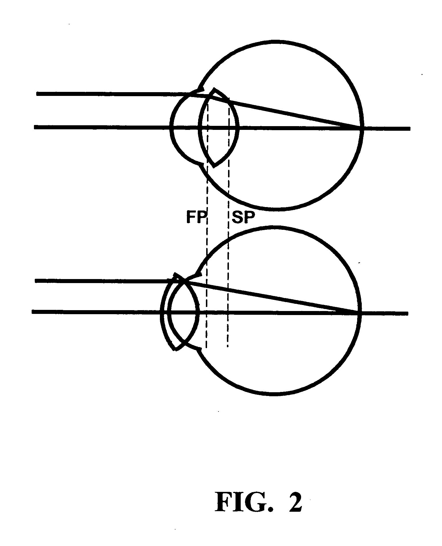 Method of calculating the required power of a toric implant