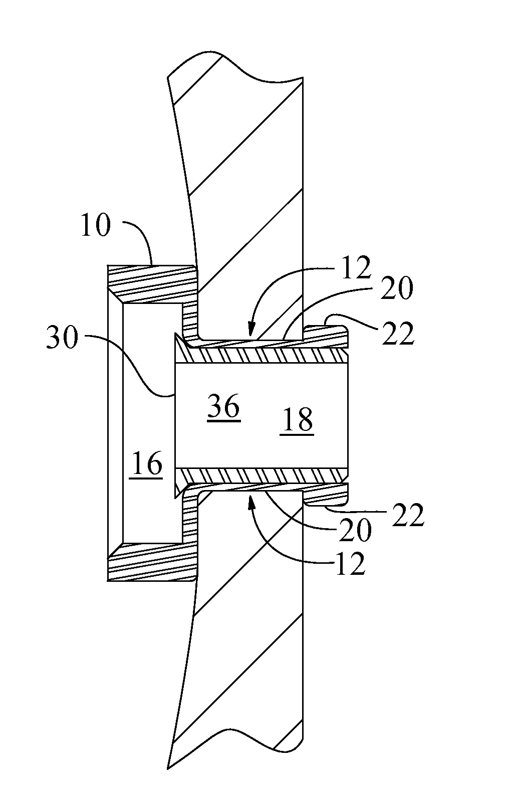 Locking device for an endostomal tracheostoma button