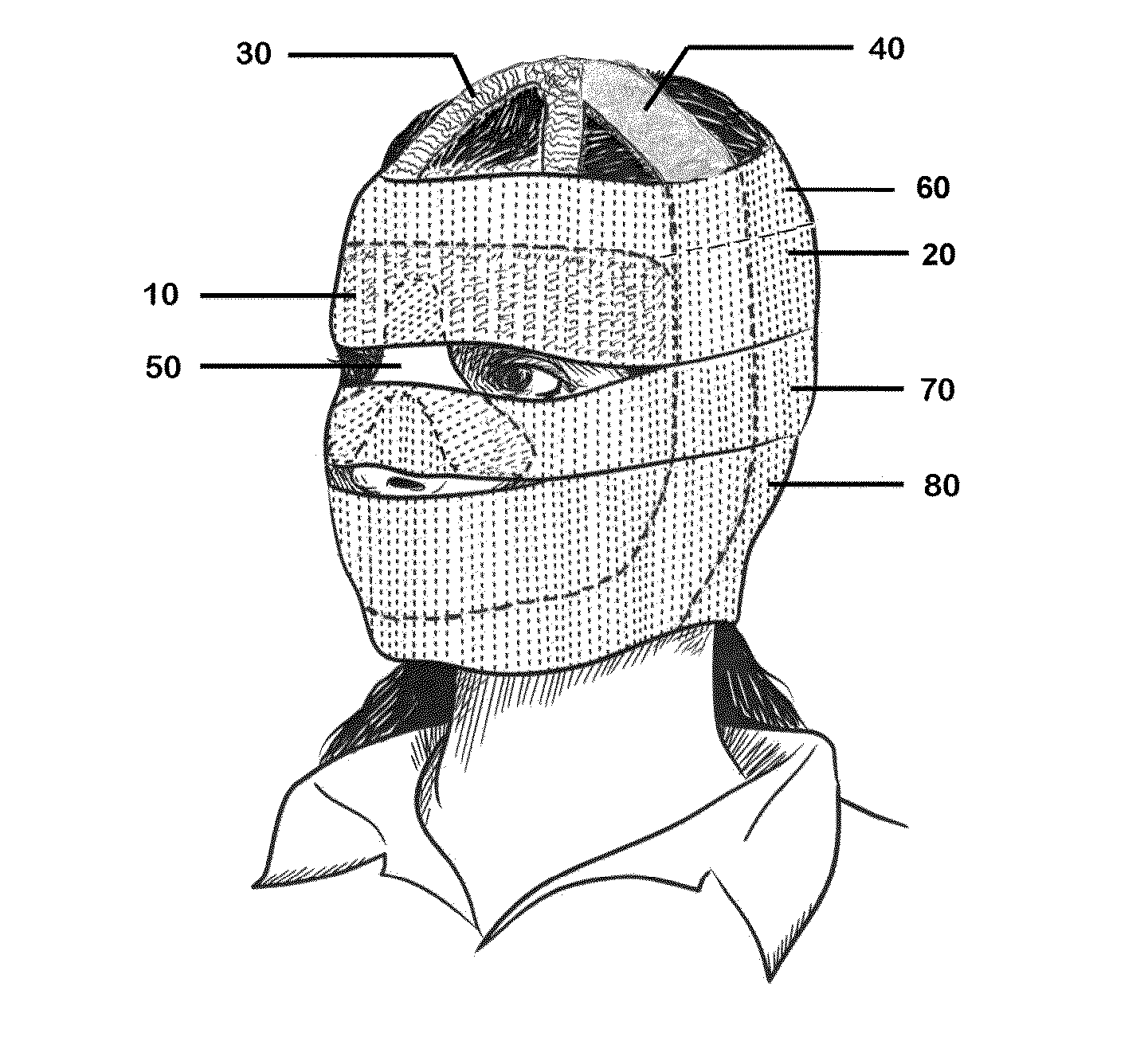 Method and apparatus of face lifting that move facial tissues up and hold