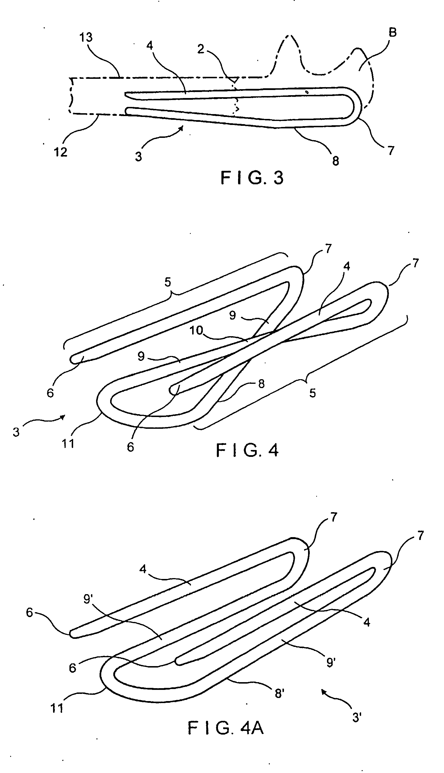 Implant device for applying compression across a fracture site