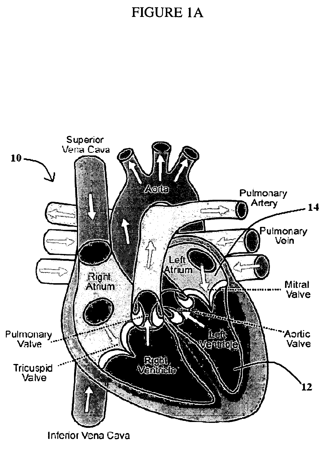 System and method for intraventricular treatment
