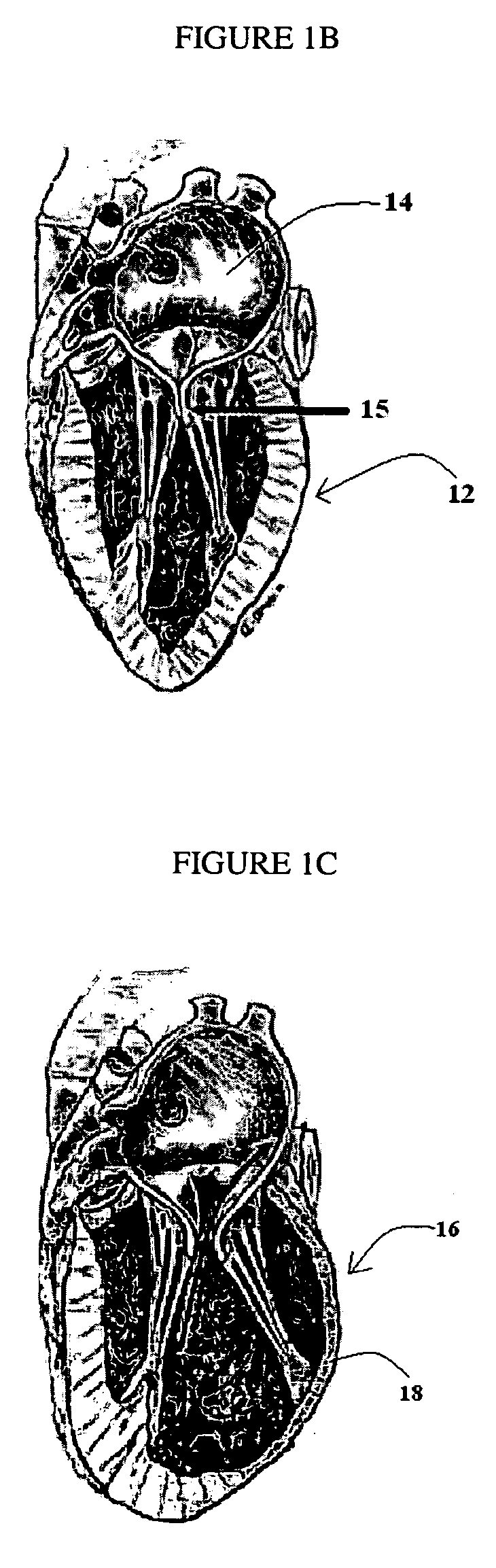 System and method for intraventricular treatment