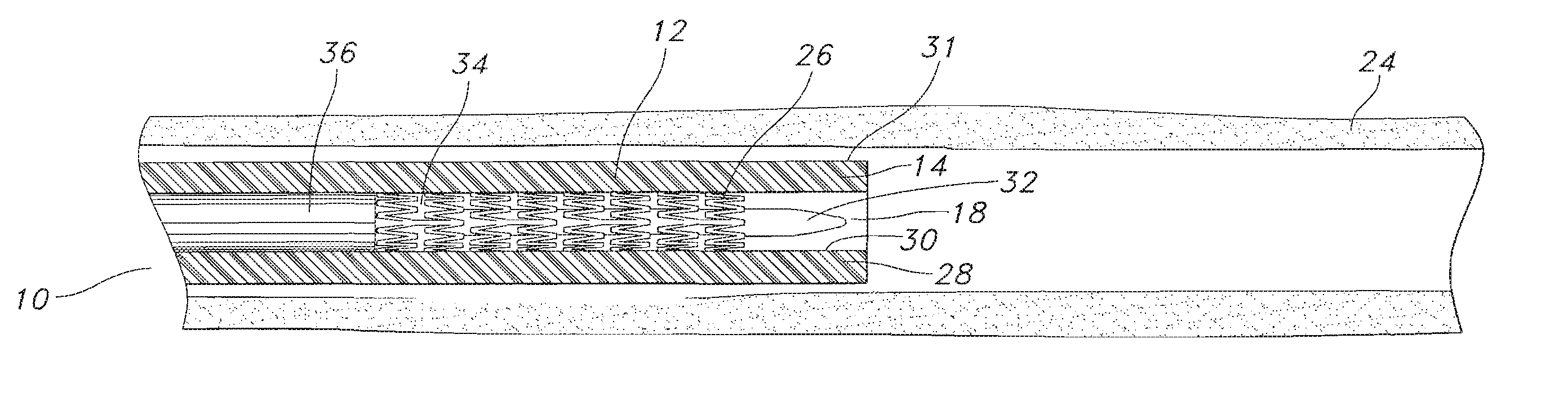 Endoscope with preloaded or preloadable stent