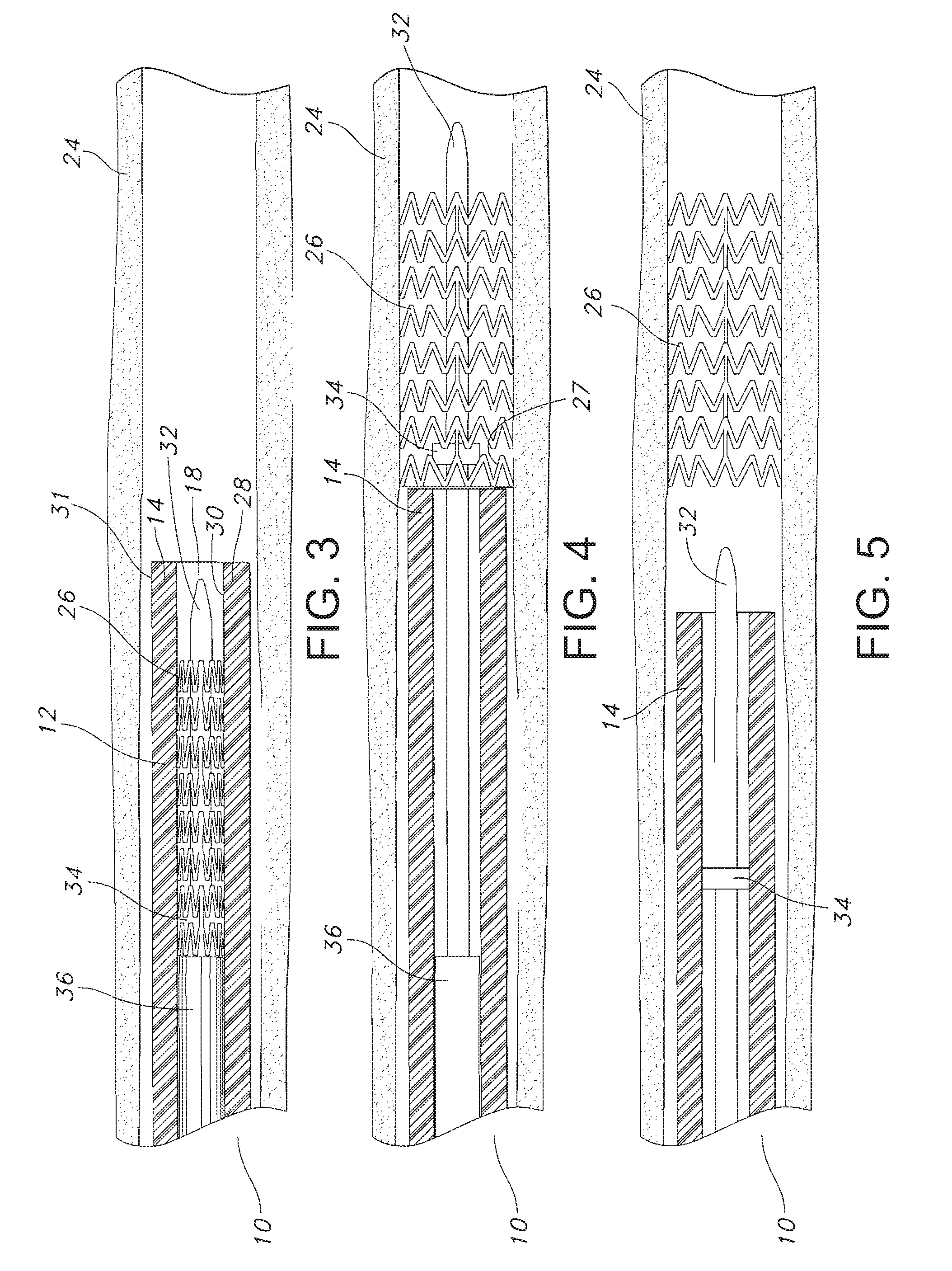 Endoscope with preloaded or preloadable stent