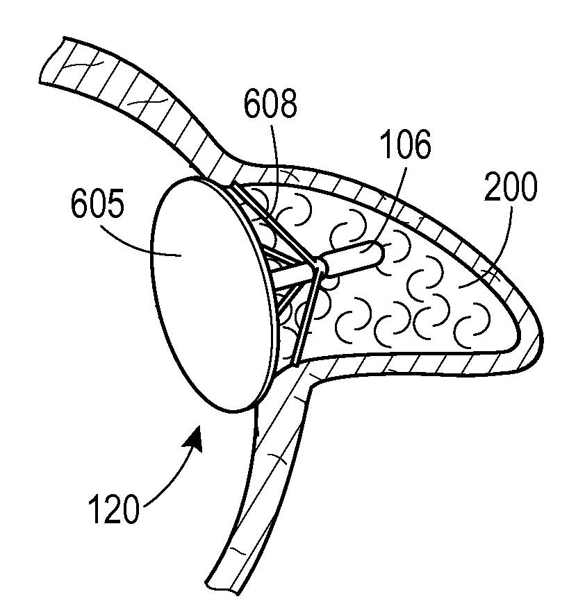 Multimodality Left Atrial Appendage Occlusion Device