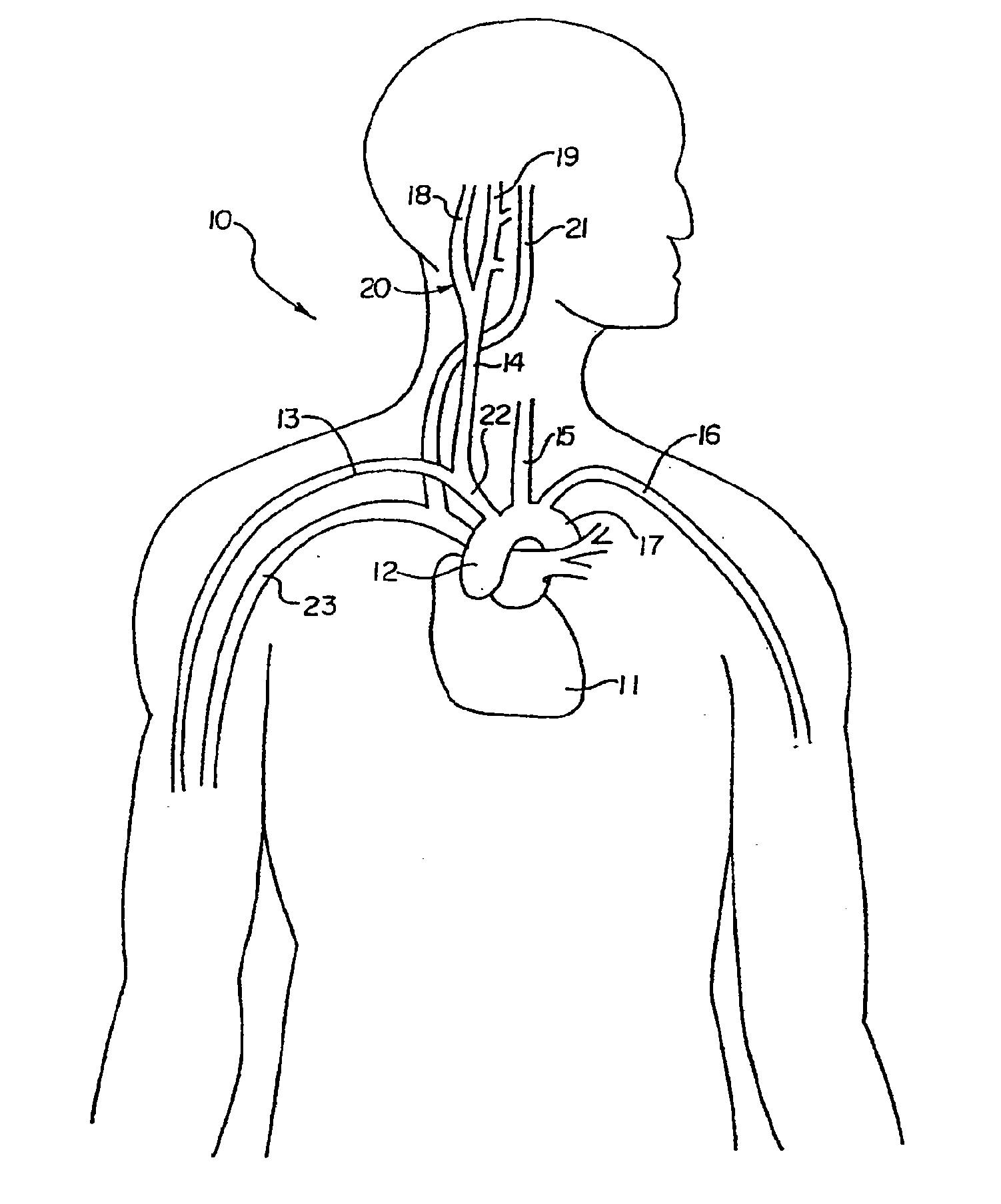 Methods and Apparatus for Pulsed Electrical Field Neuromodulation Via an Intra-to-Extravascular Approach