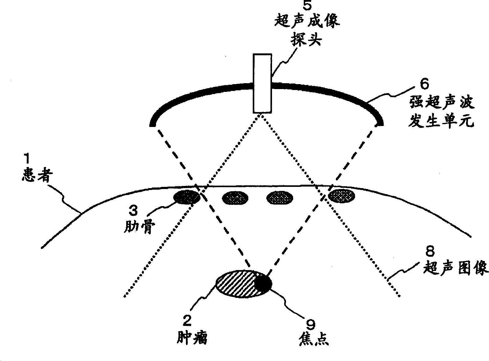 Ultrasonic radiation equipment