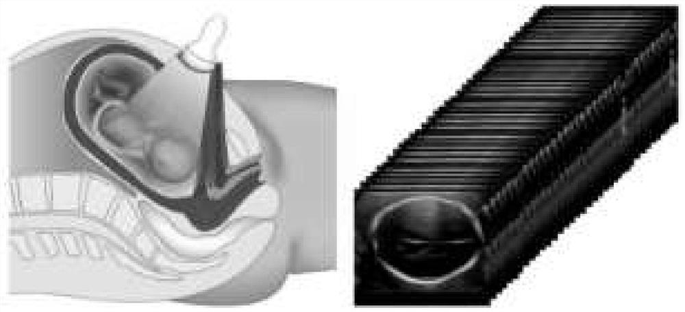 Method and system for imaging fetal brain channeling three-dimensional image in ultrasonic image