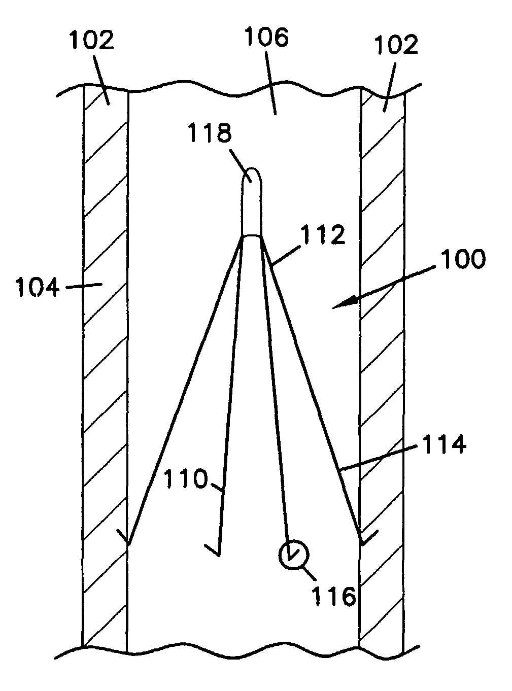 Venous filters