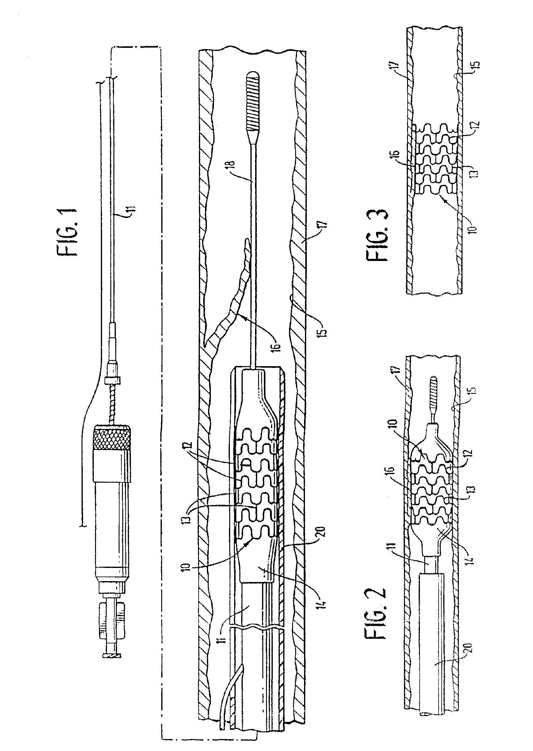 Expandable stents and method for making same