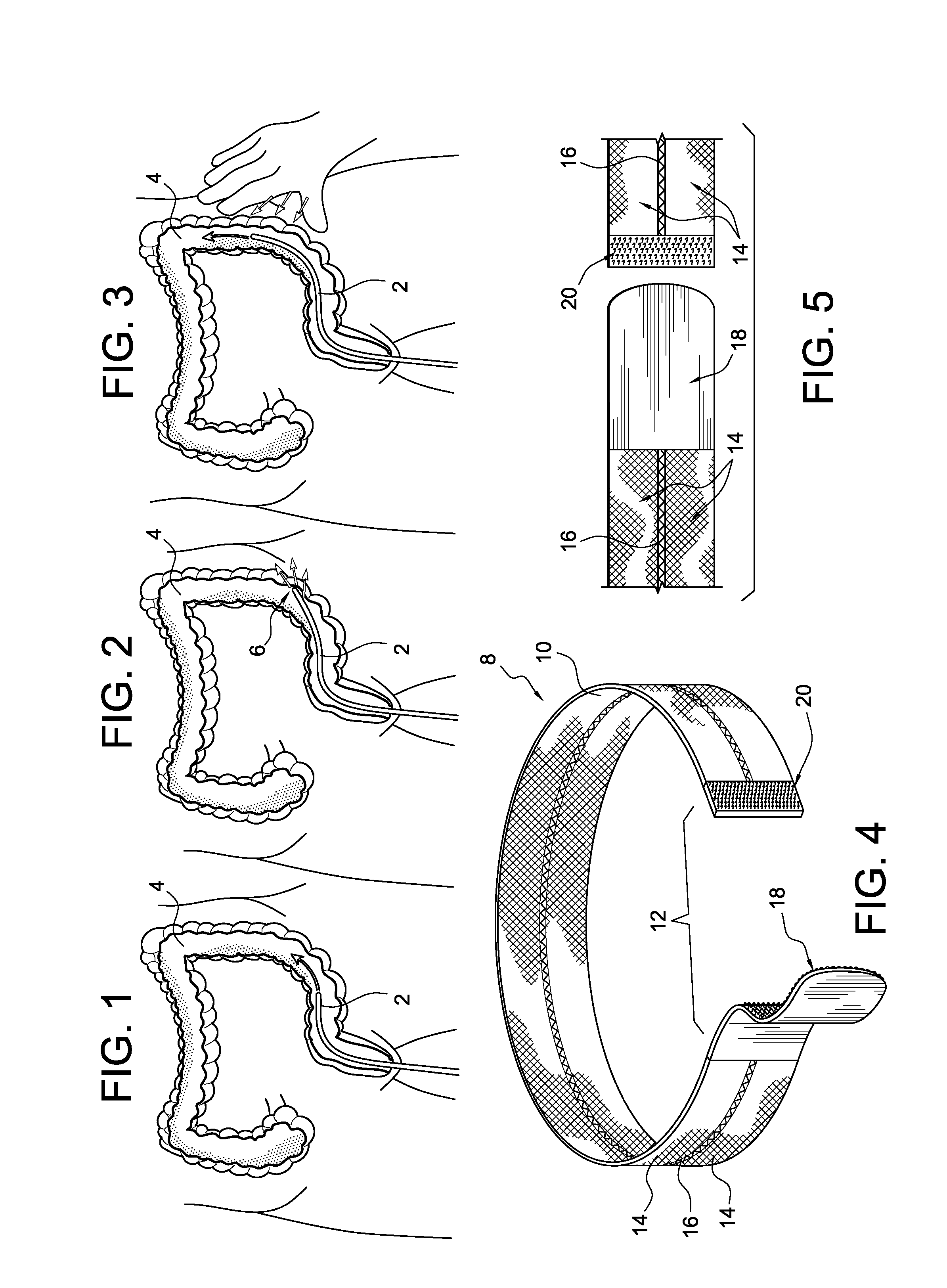 Method and apparatus for tensile colonoscopy compression