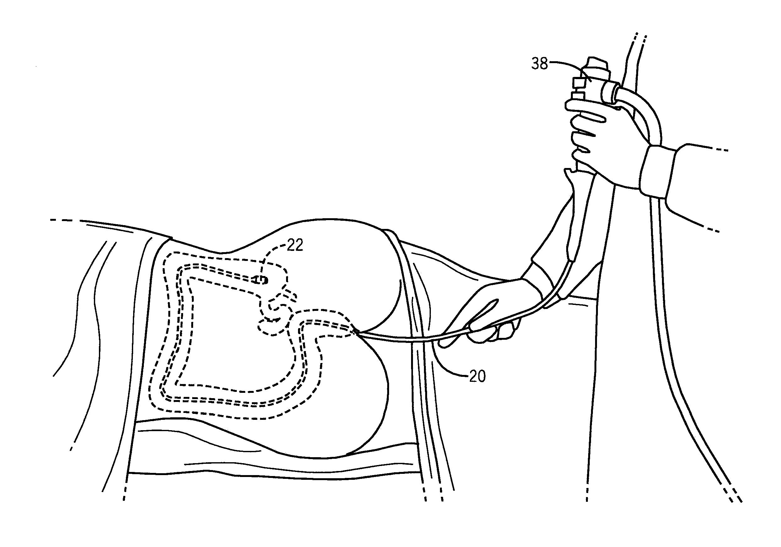 Colonoscopy systems and methods