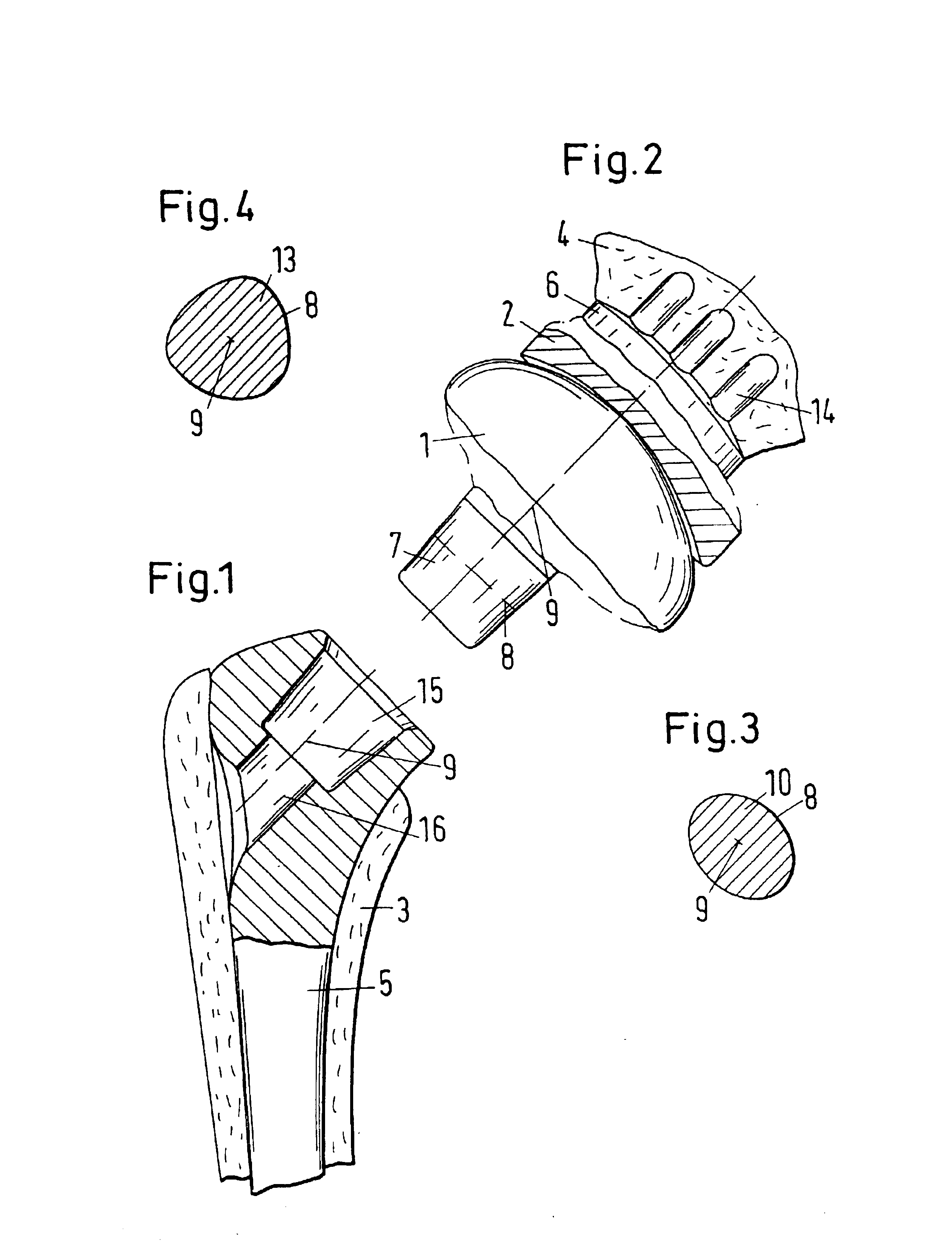 Shoulder joint prosthesis