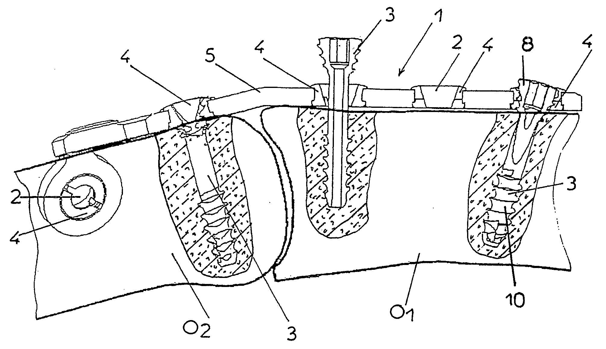 Self-locking osteosynthesis device