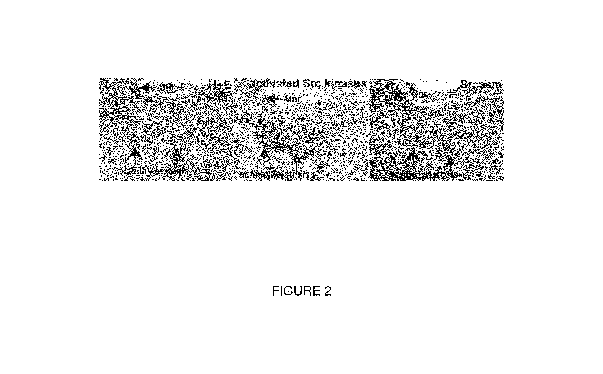 Compositions and methods for treating skin cancer associated diseases