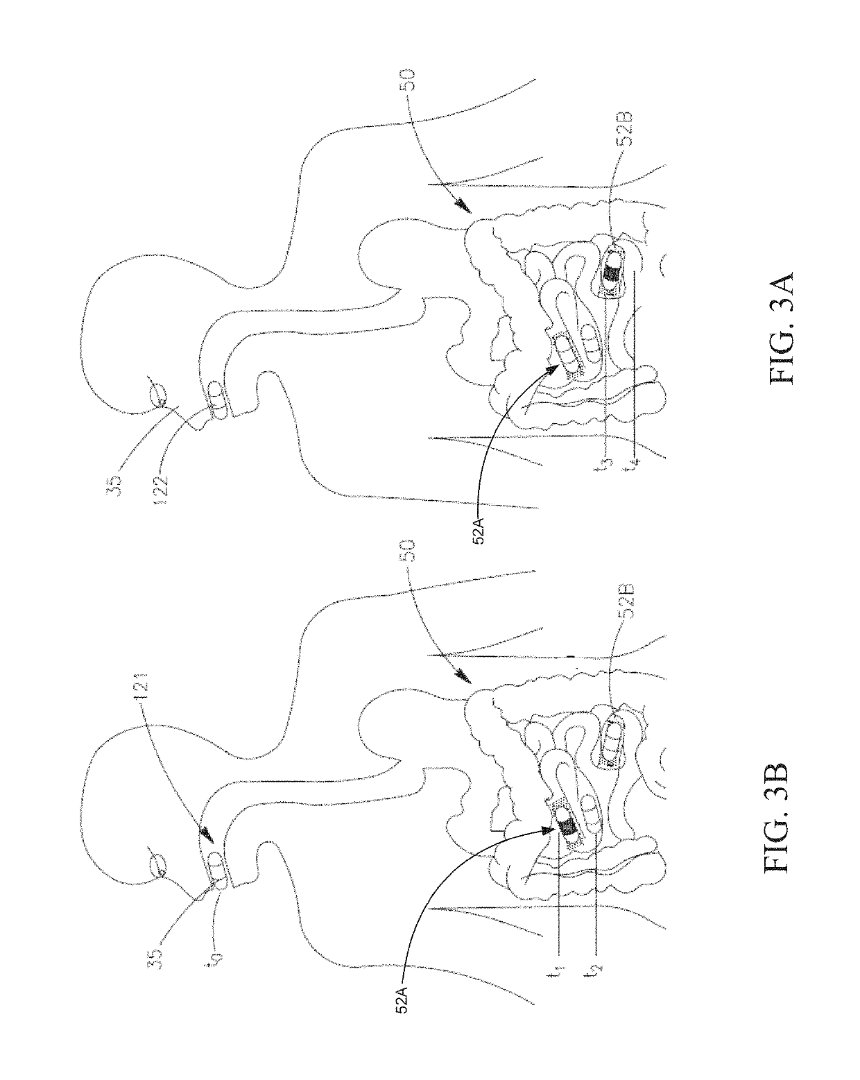 Capsule phototherapy