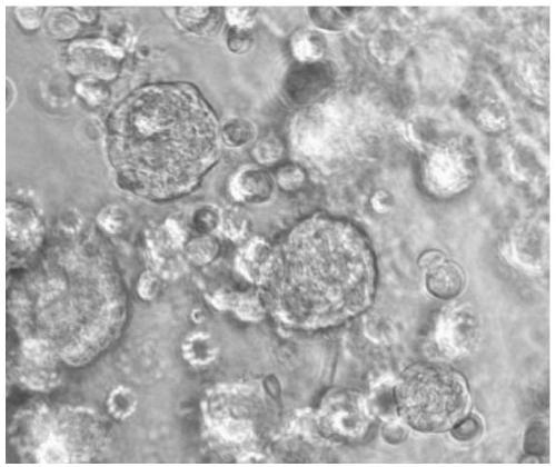 Organoid technology-based individualized lung cancer primary cell culture method