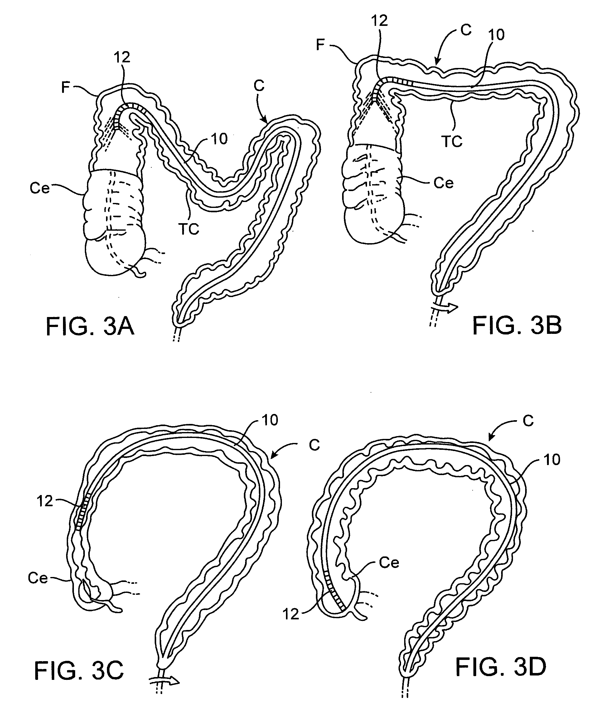 Apparatus and methods for achieving endoluminal access