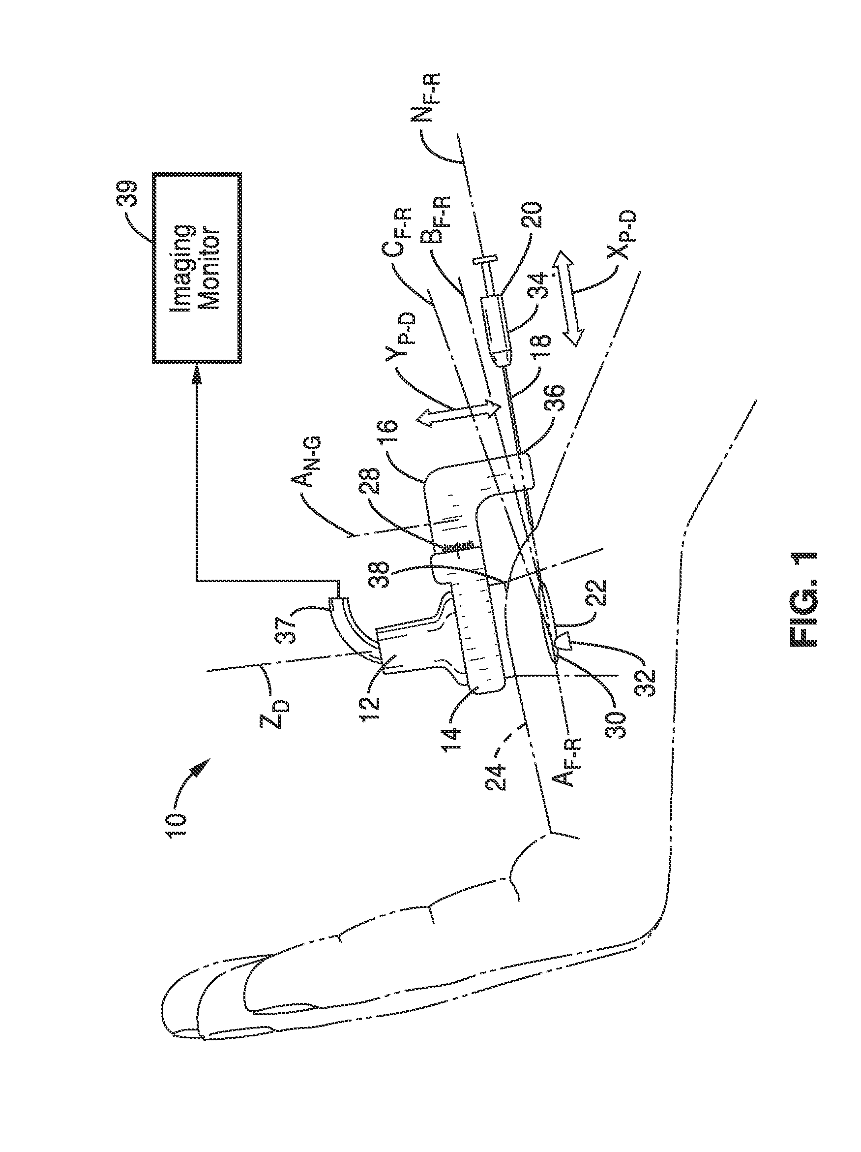 Treatment of carpal tunnel syndrome by injection of the flexor retinaculum