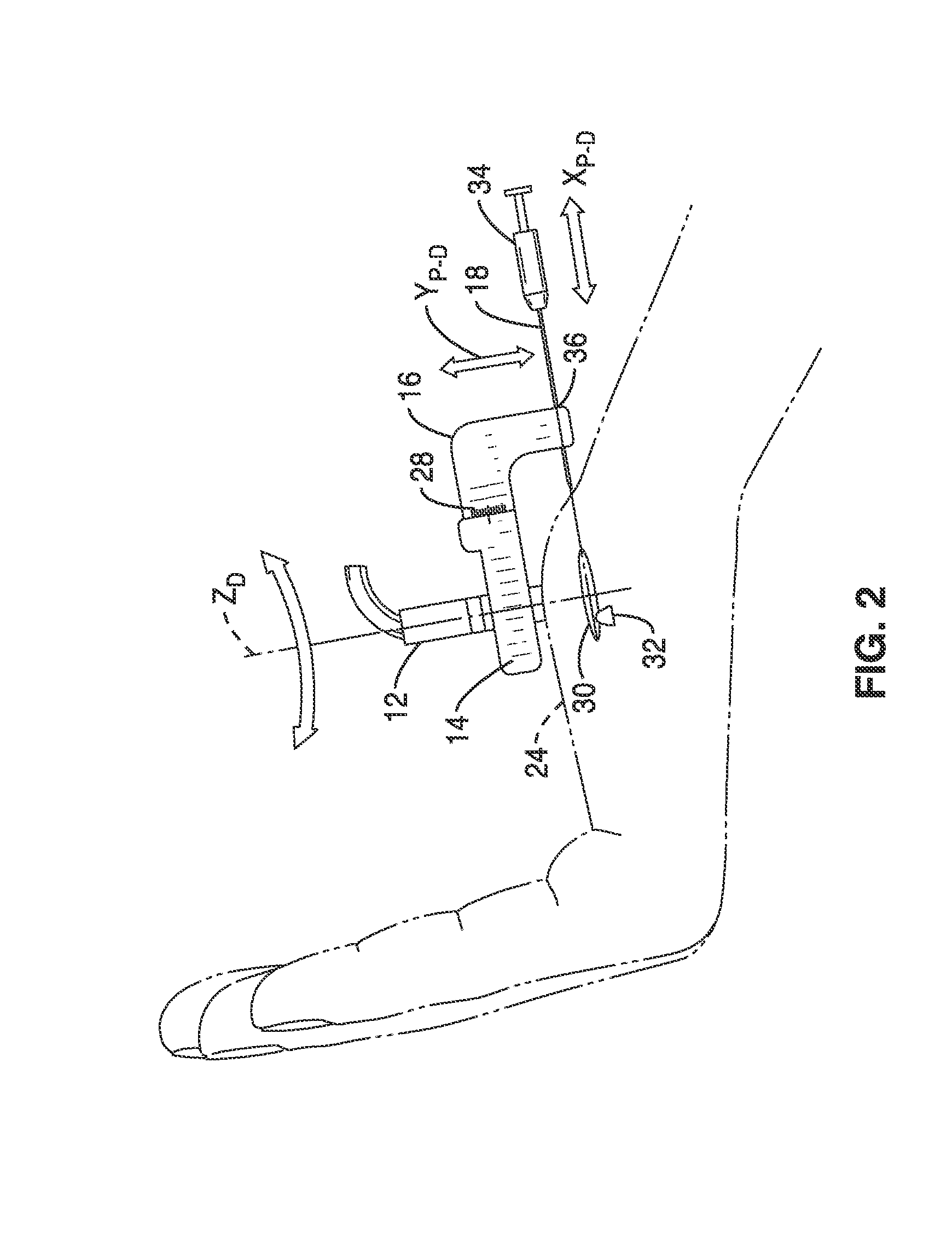 Treatment of carpal tunnel syndrome by injection of the flexor retinaculum