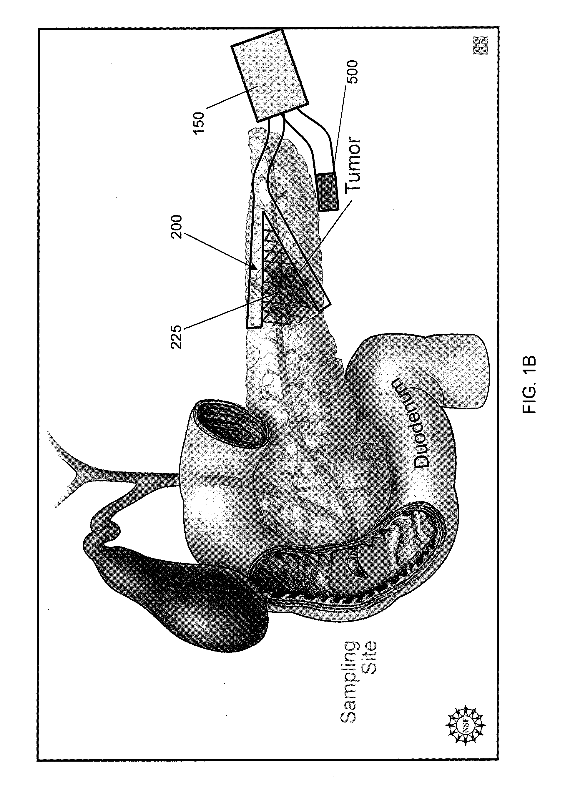 Interventional drug delivery system and associated methods