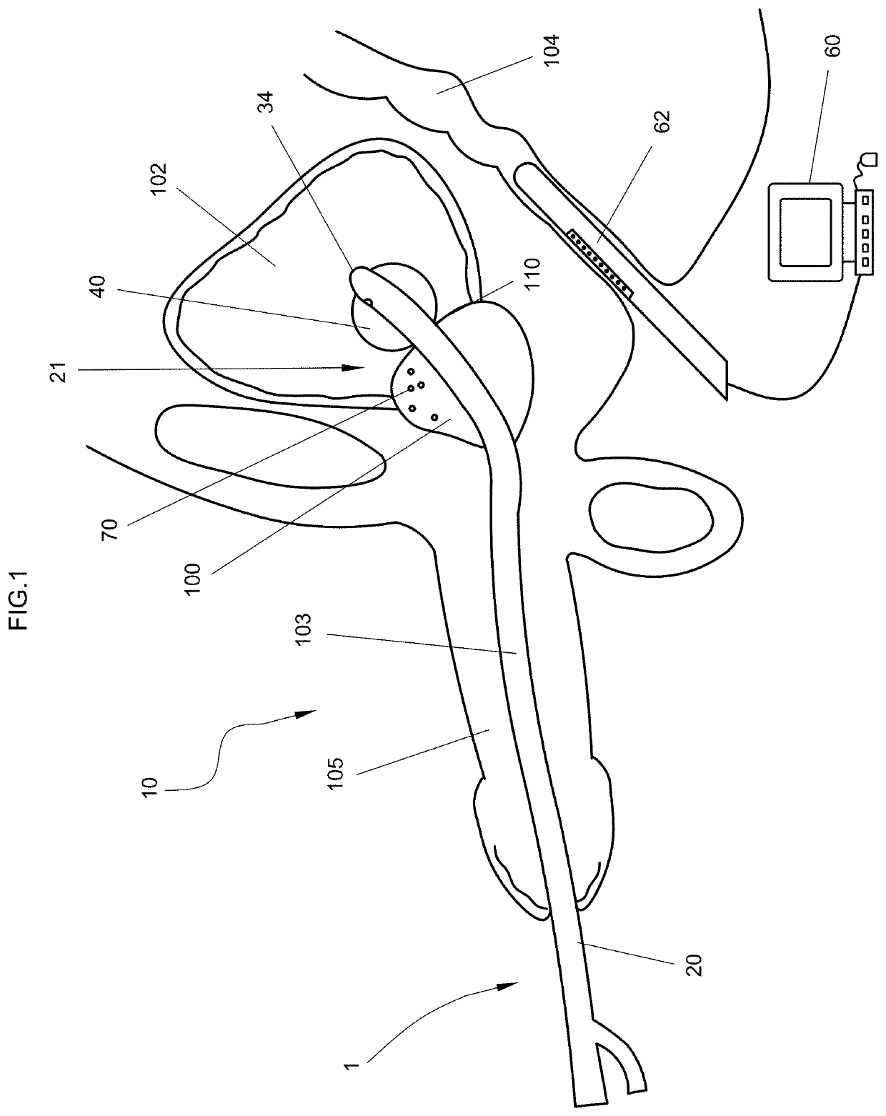 Echo-opaque urethral catheter