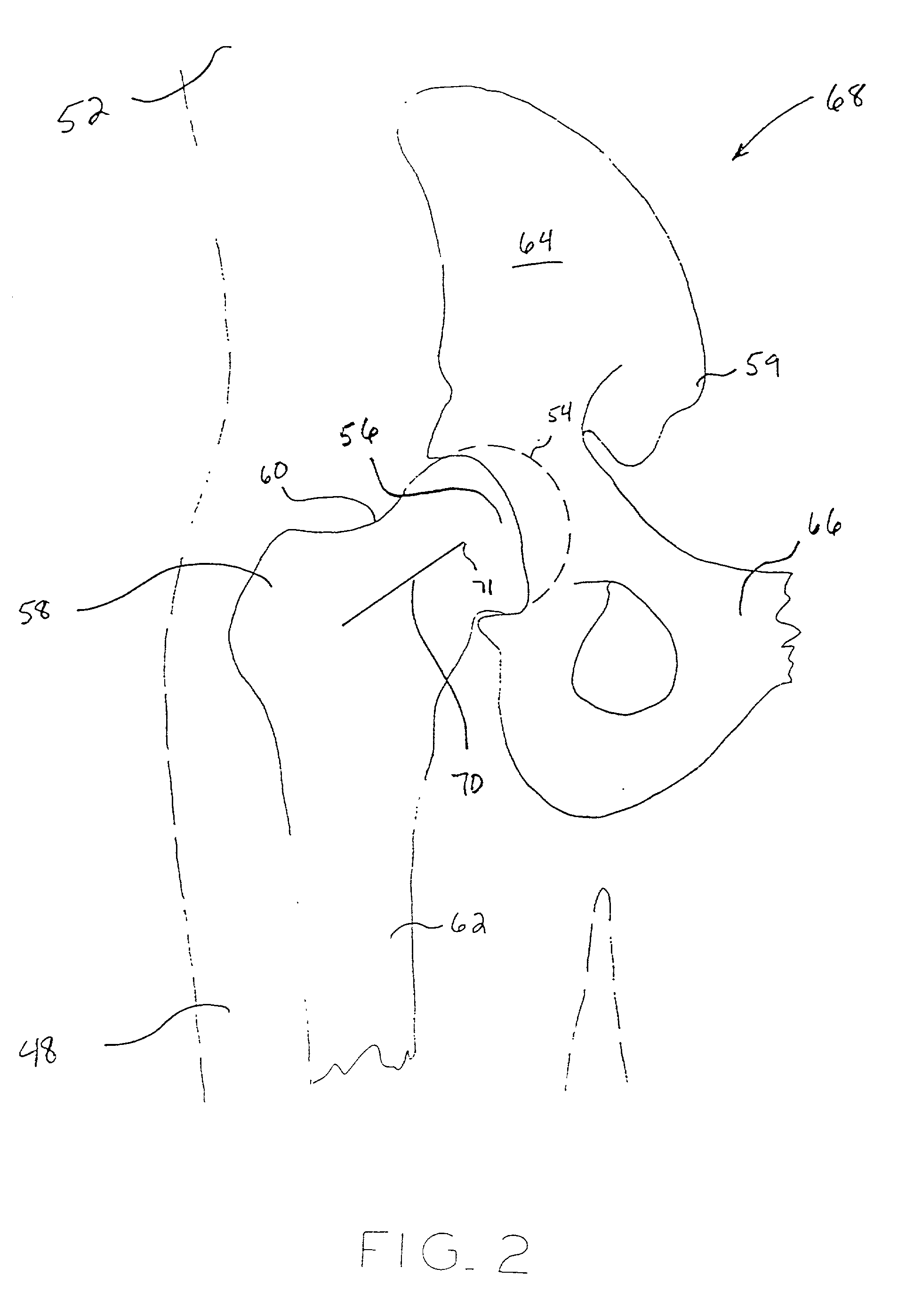 Method and apparatus for performing a minimally invasive total hip arthroplasty