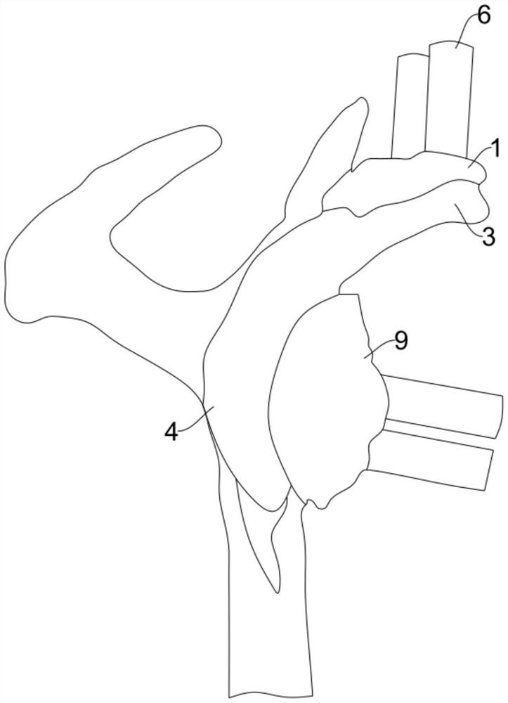 Precise displacement guide plate for Latarjet operation and using method thereof