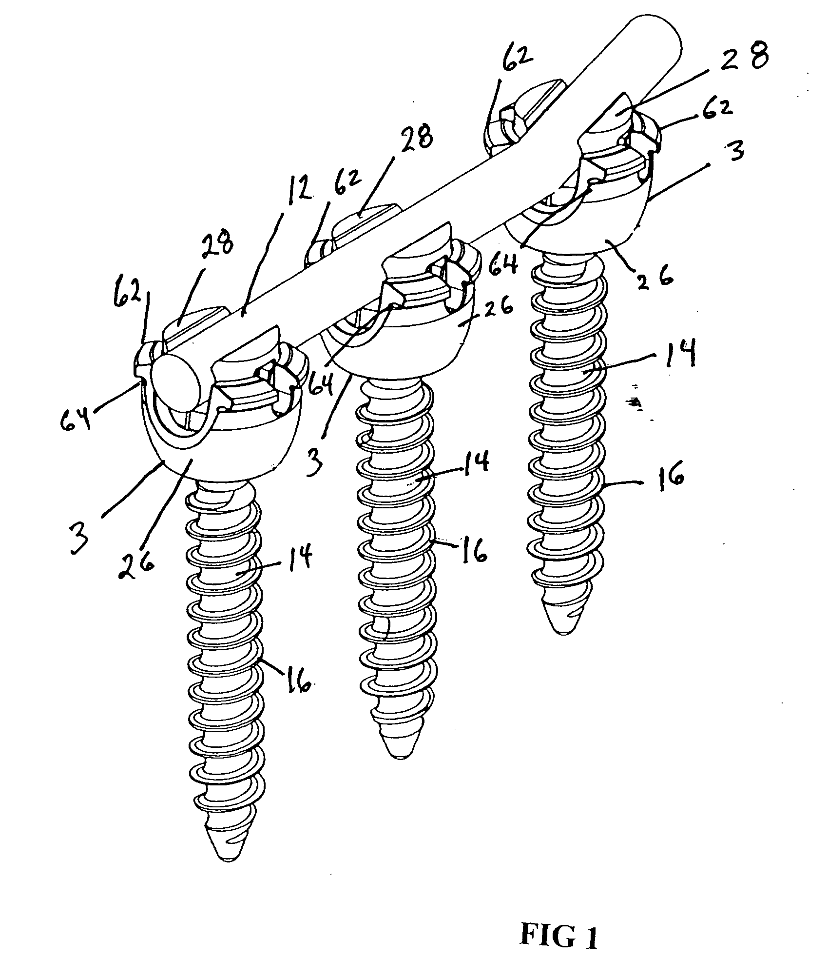 Spinal fixation system having locking and unlocking devices for use with a multi-planar, taper lock screw