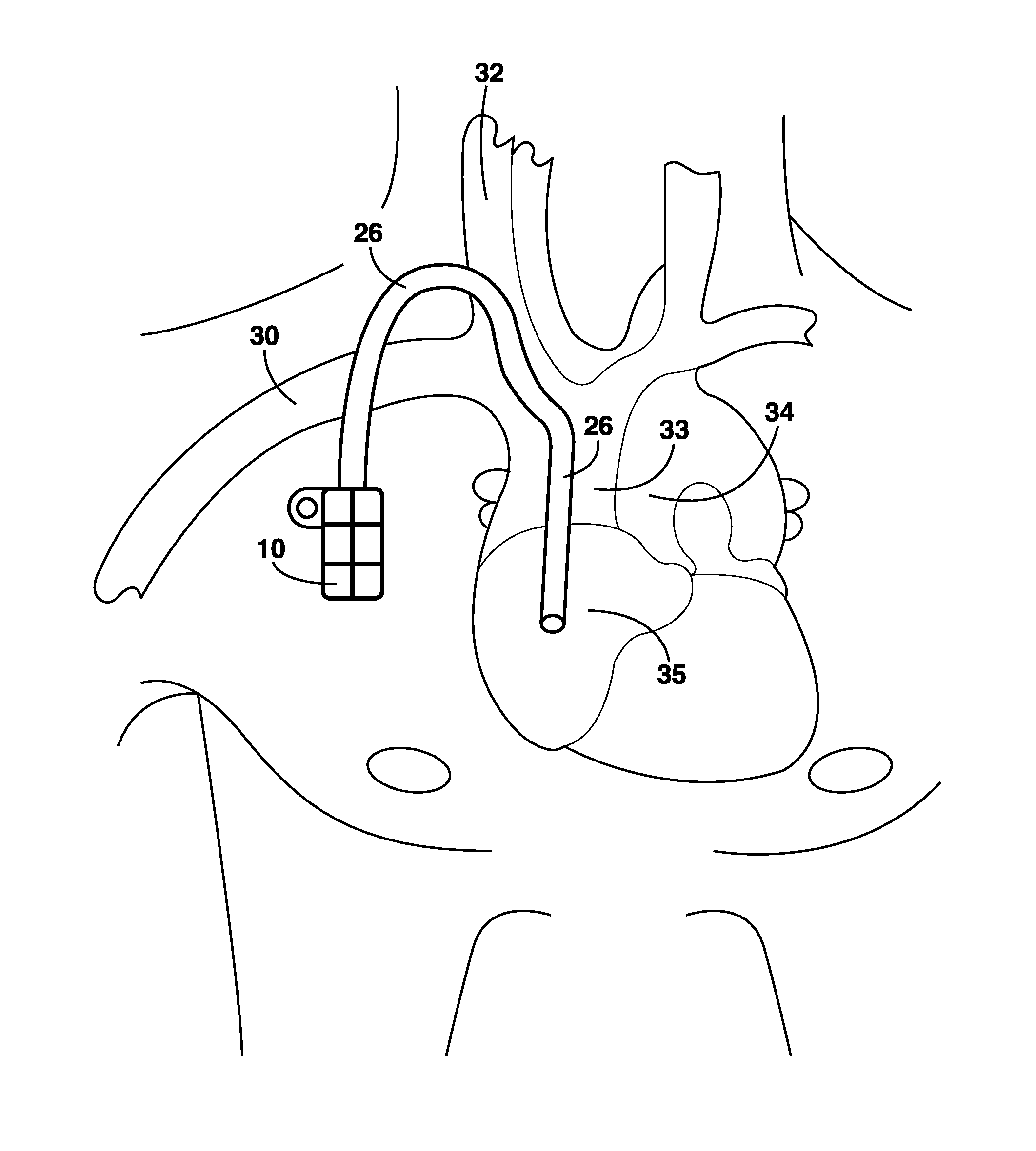 Implantable high flow multi-window vascular access port catheter