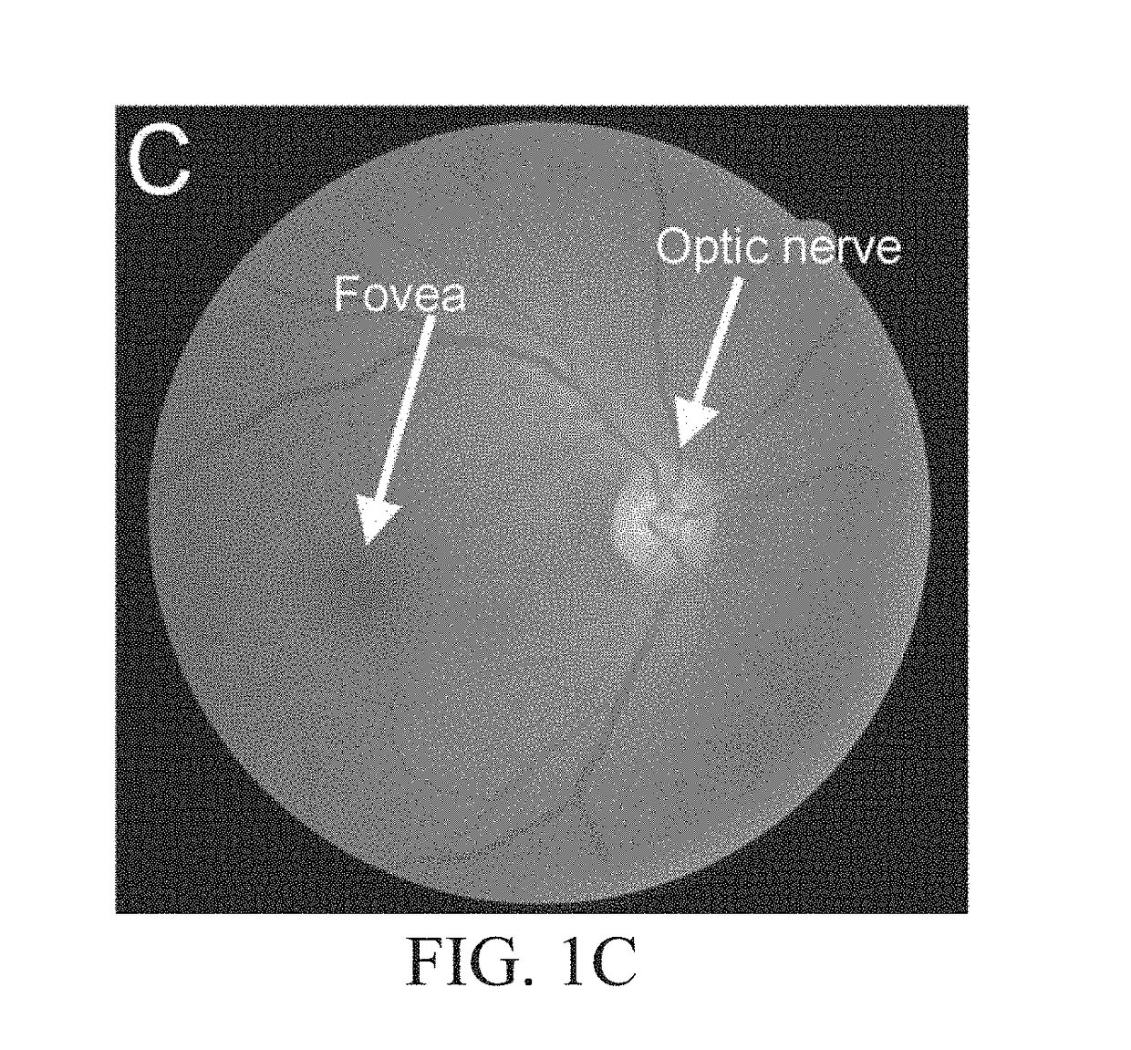 Self-illuminated handheld lens for retinal examination and photography and related method thereof