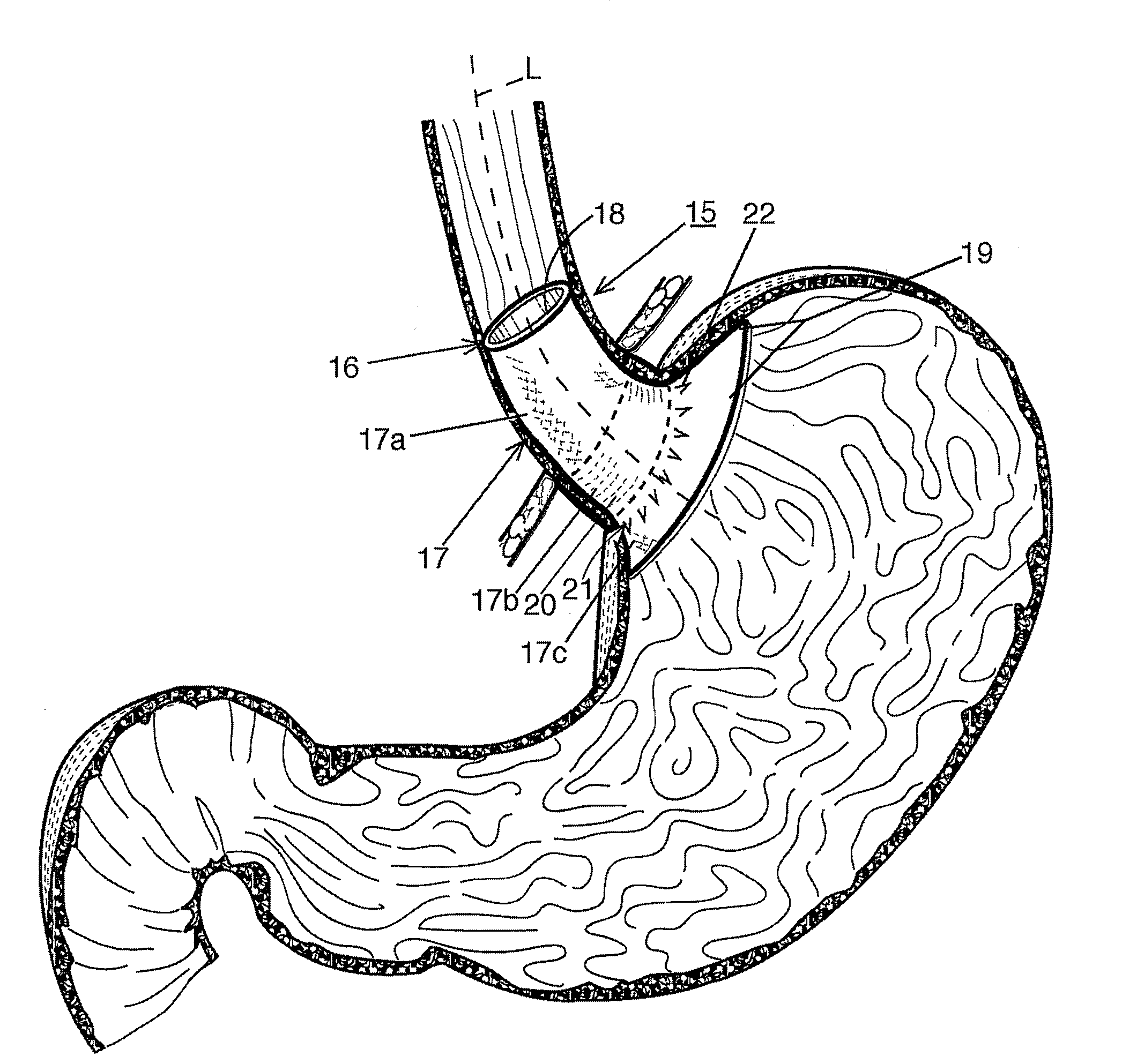 Bariatric device and method