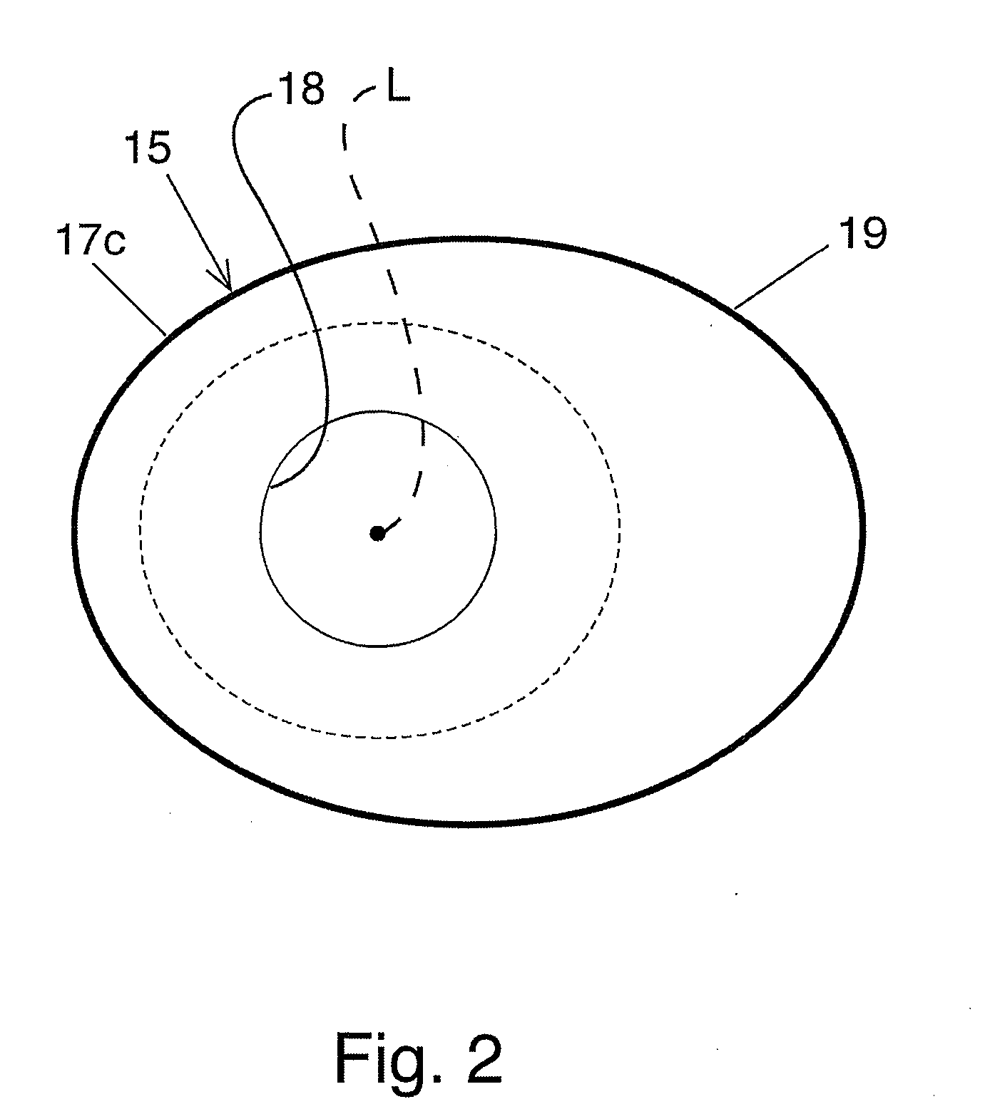 Bariatric device and method